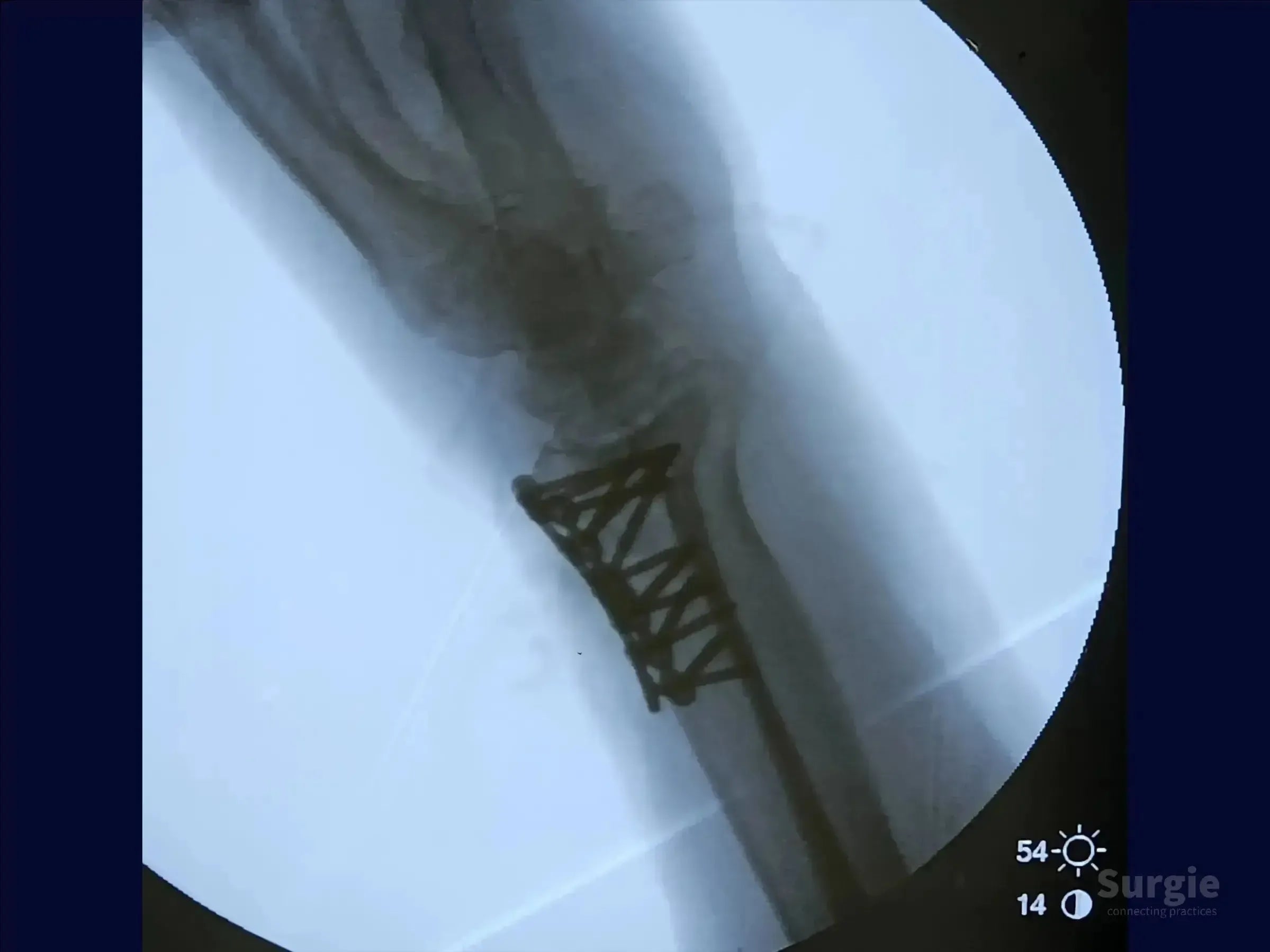 X-ray showing a dorsal Barton's fracture of the radius stabilized with a metallic fixation plate and screws.