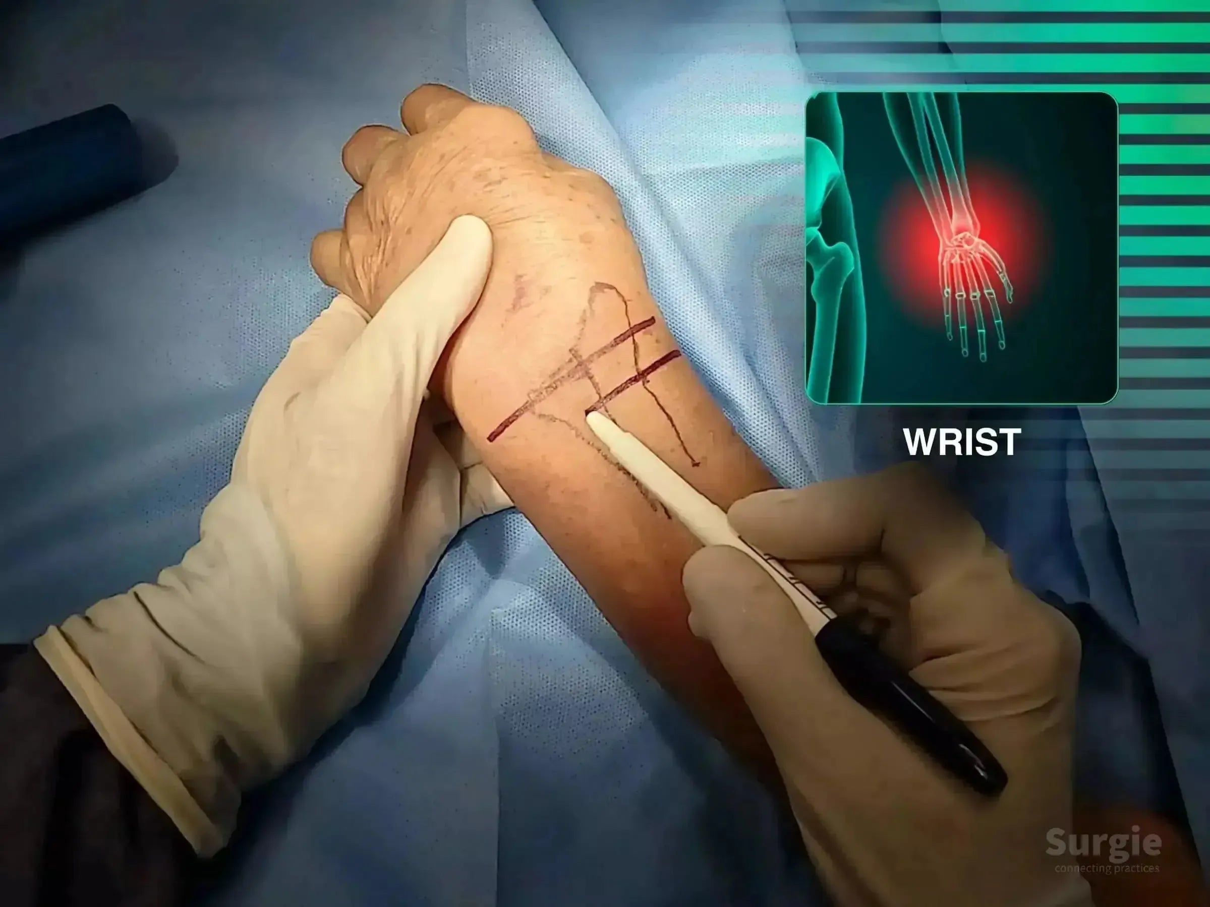 Surgeon marking a dorsal Barton's fracture site on a patient's wrist with an anatomical overlay showing the injury.