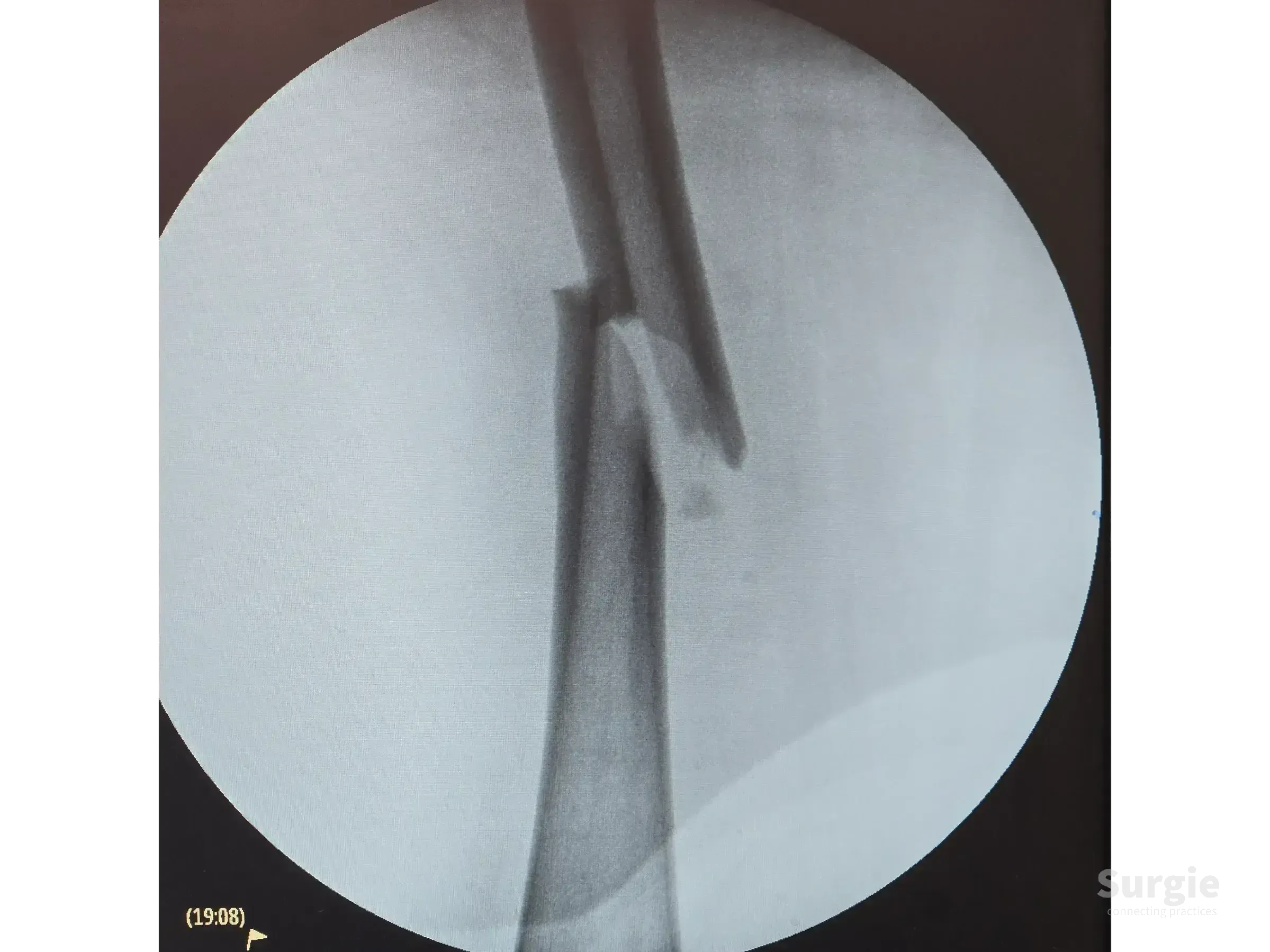 Fluoroscopic X-ray showing a displaced femoral shaft fracture with bone misalignment for intramedullary nail planning.