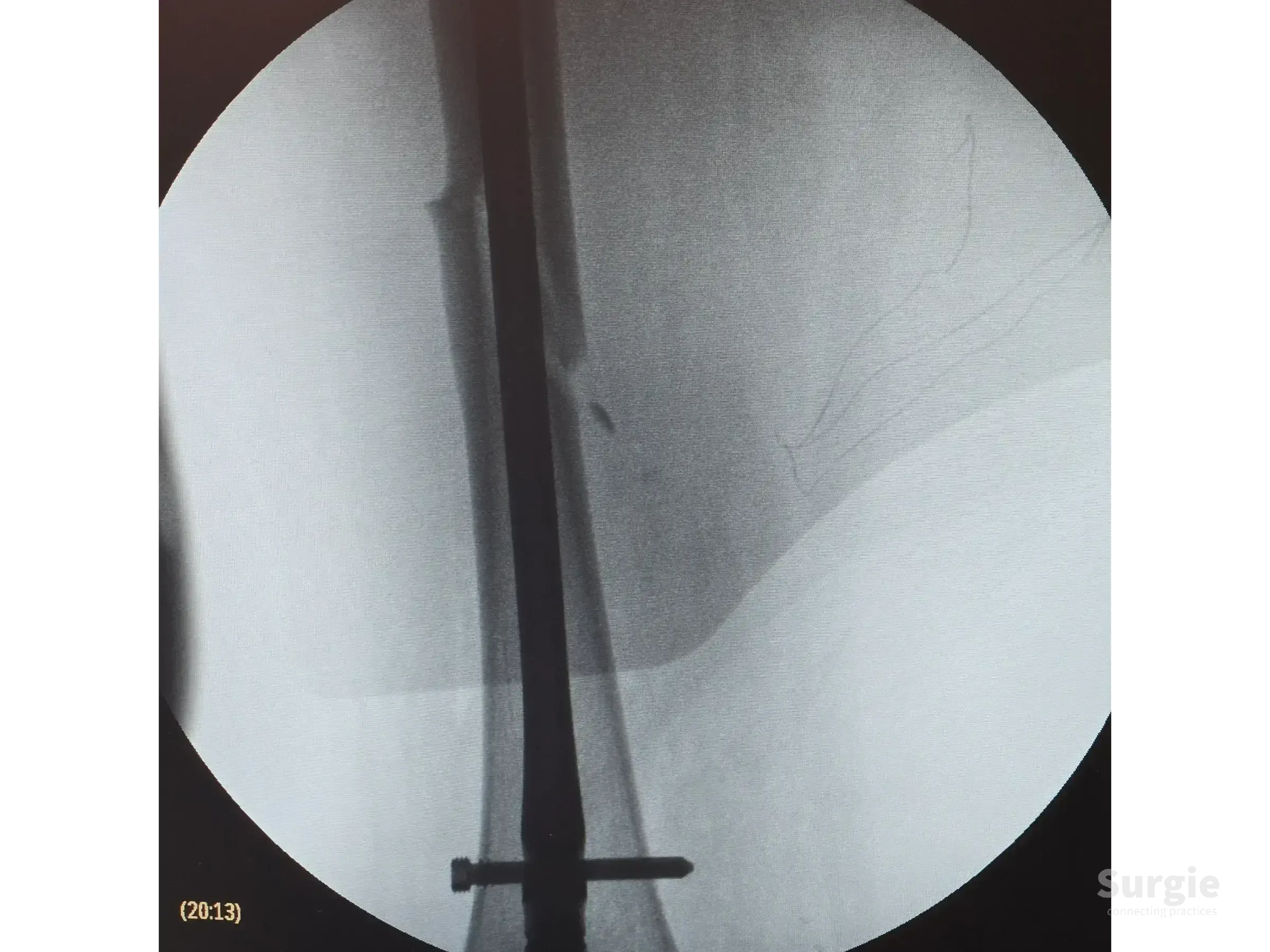 Fluoroscopic view of a femoral shaft fracture stabilized with a metal retrograde intramedullary nail and locking screw.