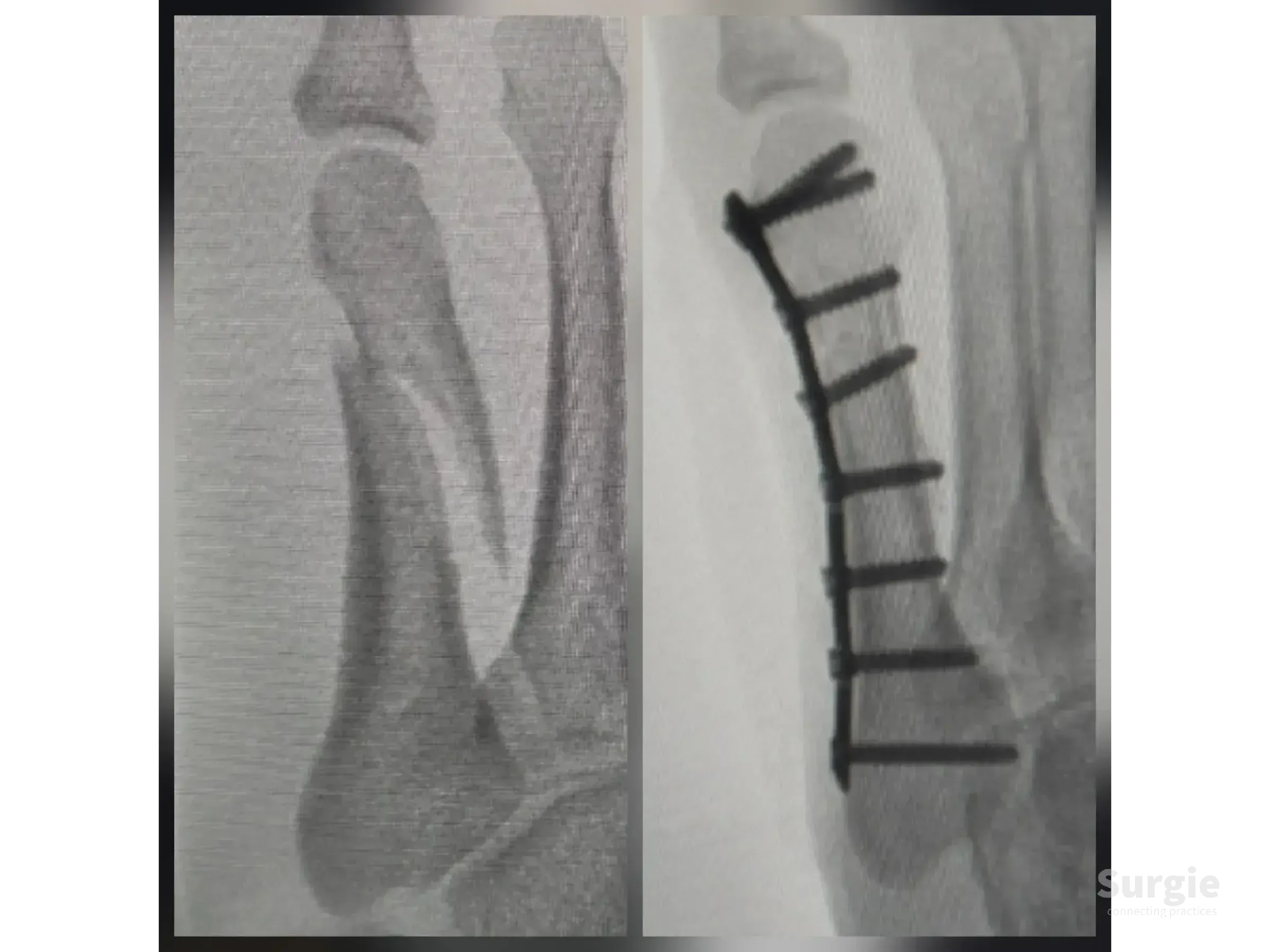 X-ray showing a displaced fifth metatarsal fracture before and after fixation with a 2.0 mm titanium locking plate and screws.