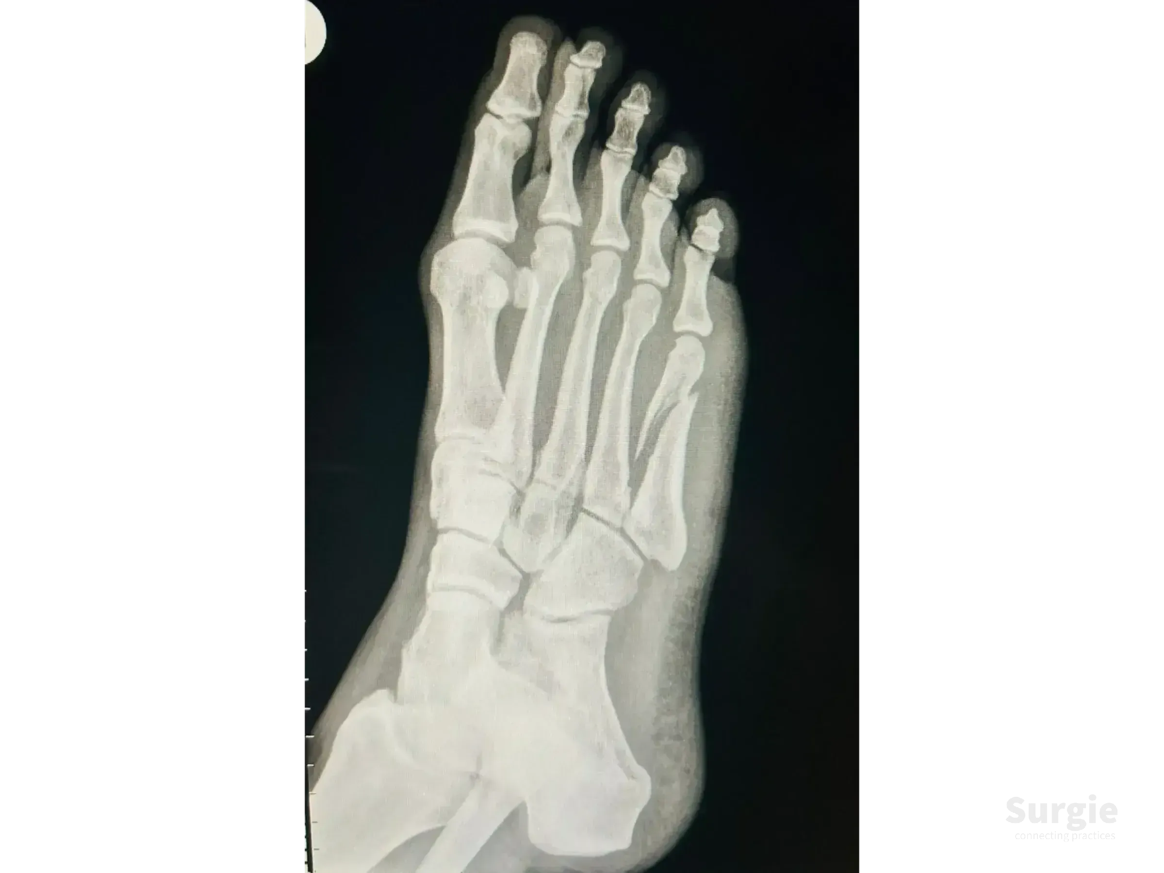 X-ray of a displaced fifth metatarsal fracture stabilized with a 2.0 mm low-profile titanium locking plate and screws.