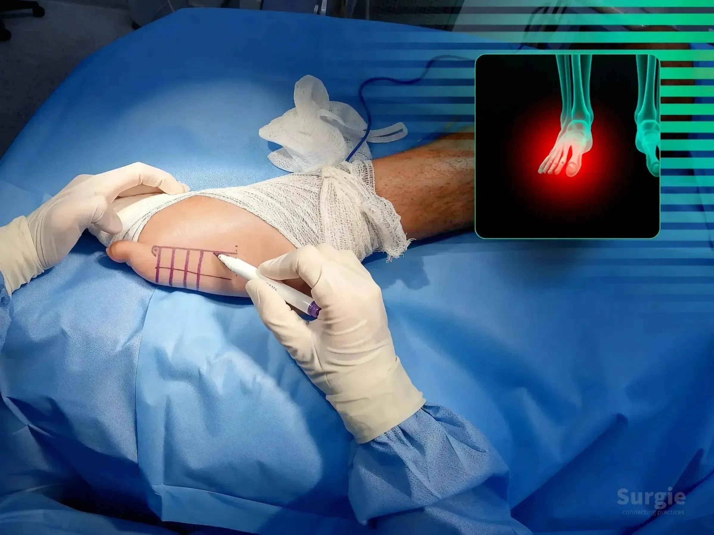 Surgeon marking a fifth metatarsal fracture site on a patient's foot with an anatomical X-ray overlay.