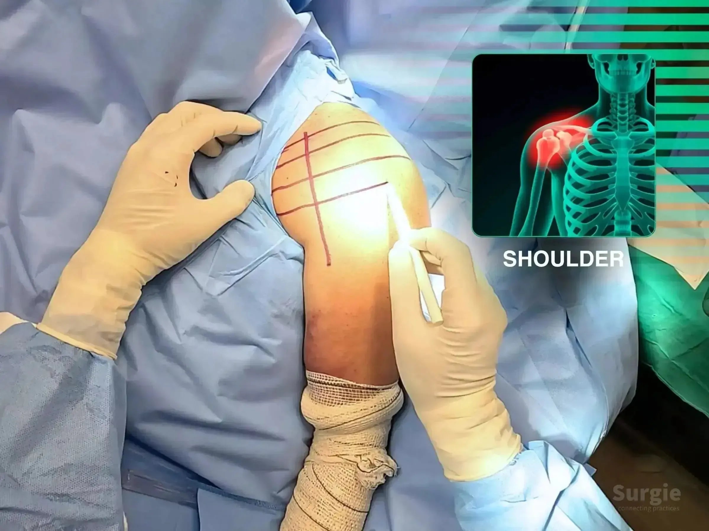 Surgeon marking a patient's shoulder for a deltopectoral approach with a skeletal diagram overlay showing a humerus fracture.