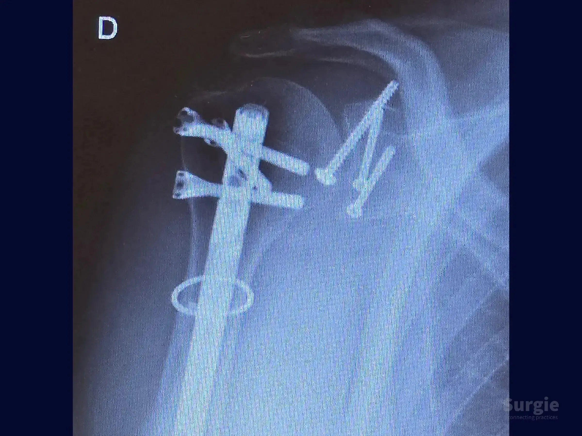 X-ray showing metallic compression screws and fixation hardware implanted in a fractured glenoid shoulder joint.
