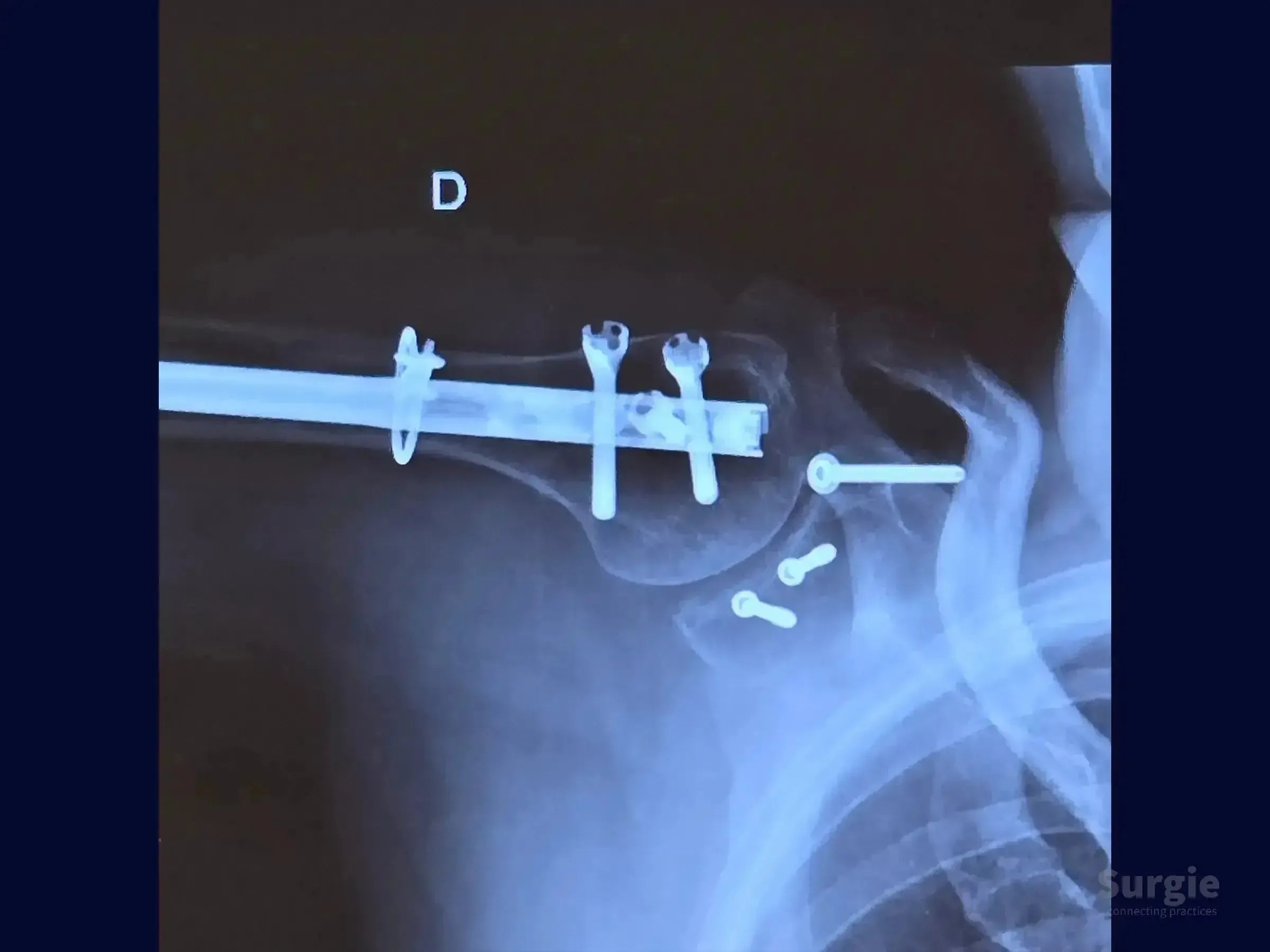 X-ray showing glenoid fracture fixation with metallic compression screws and an intramedullary nail in the shoulder.