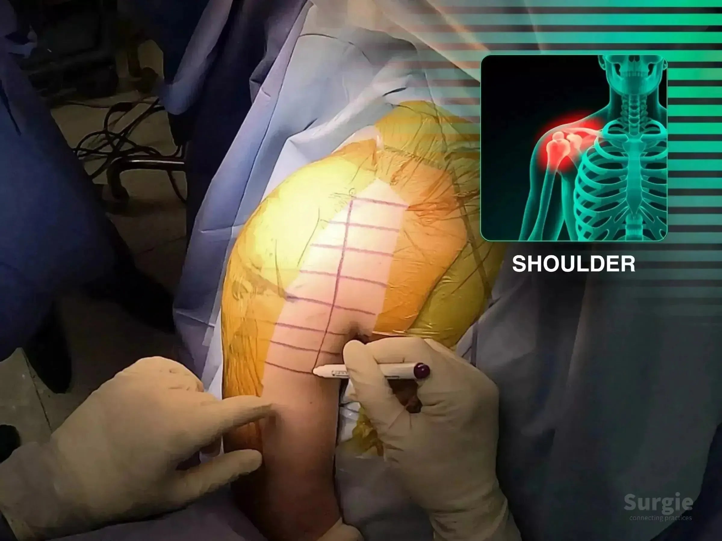 Surgeon marking a shoulder incision site with a grid, featuring an anatomical overlay of the glenoid joint.