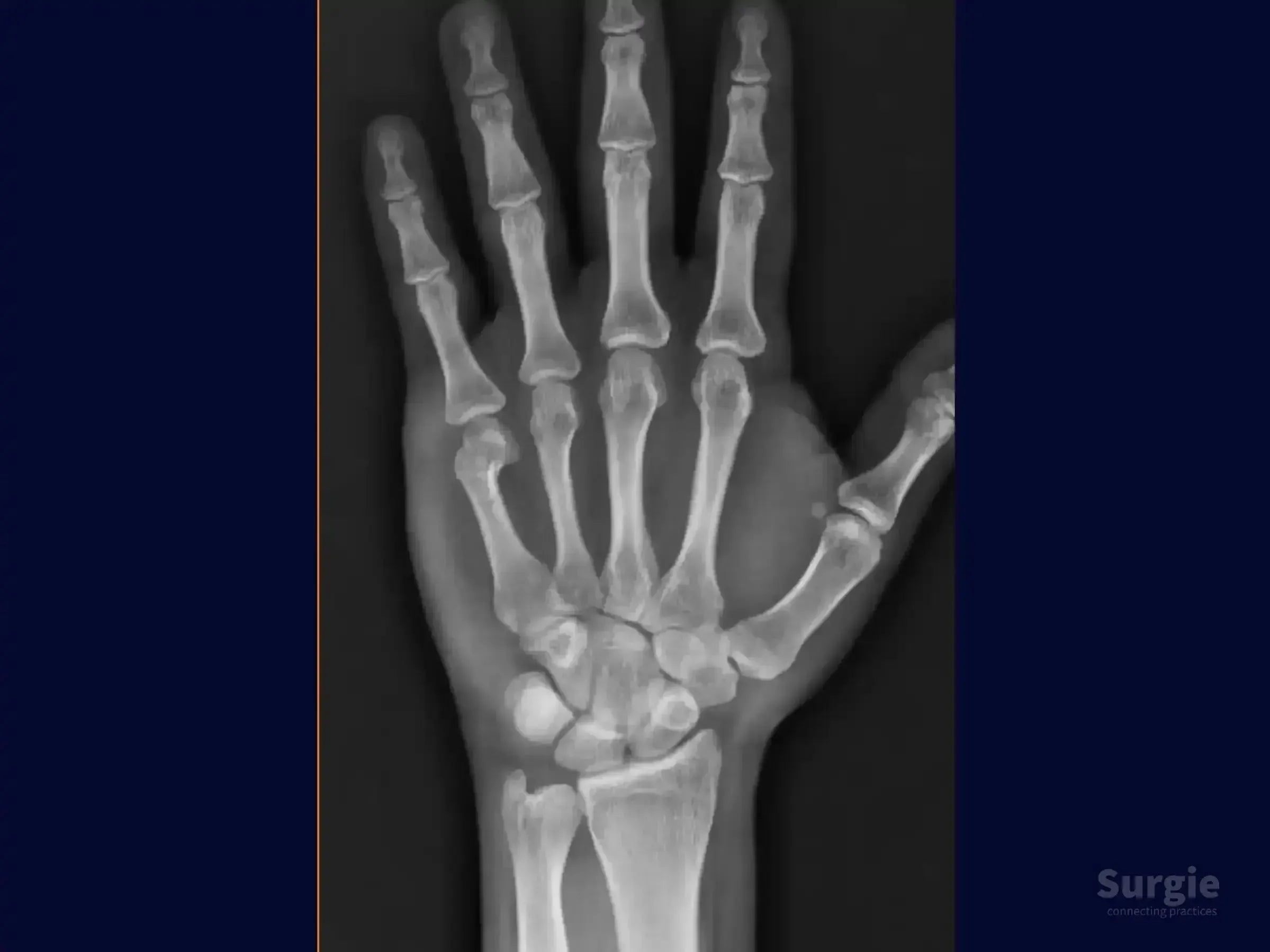 Anteroposterior hand X-ray showing a displaced fracture of the fifth metacarpal neck, known as a boxer's fracture.