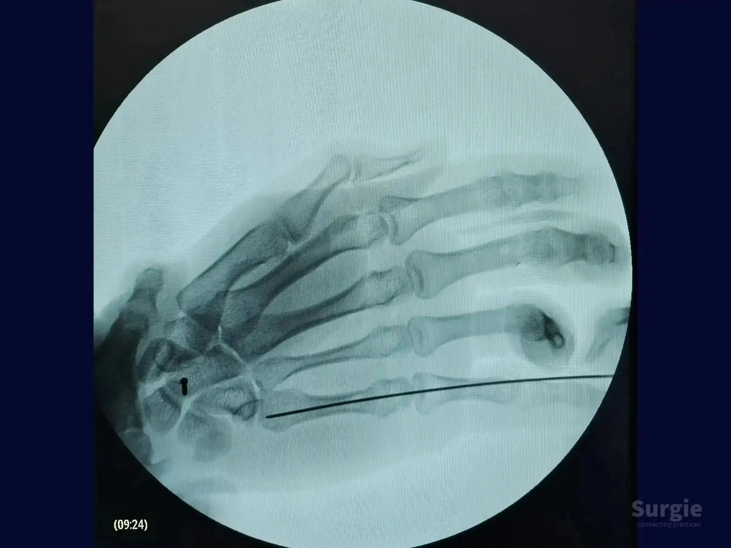 Fluoroscopic X-ray showing a guidewire inserted into the fifth metacarpal for boxer's fracture surgical fixation.