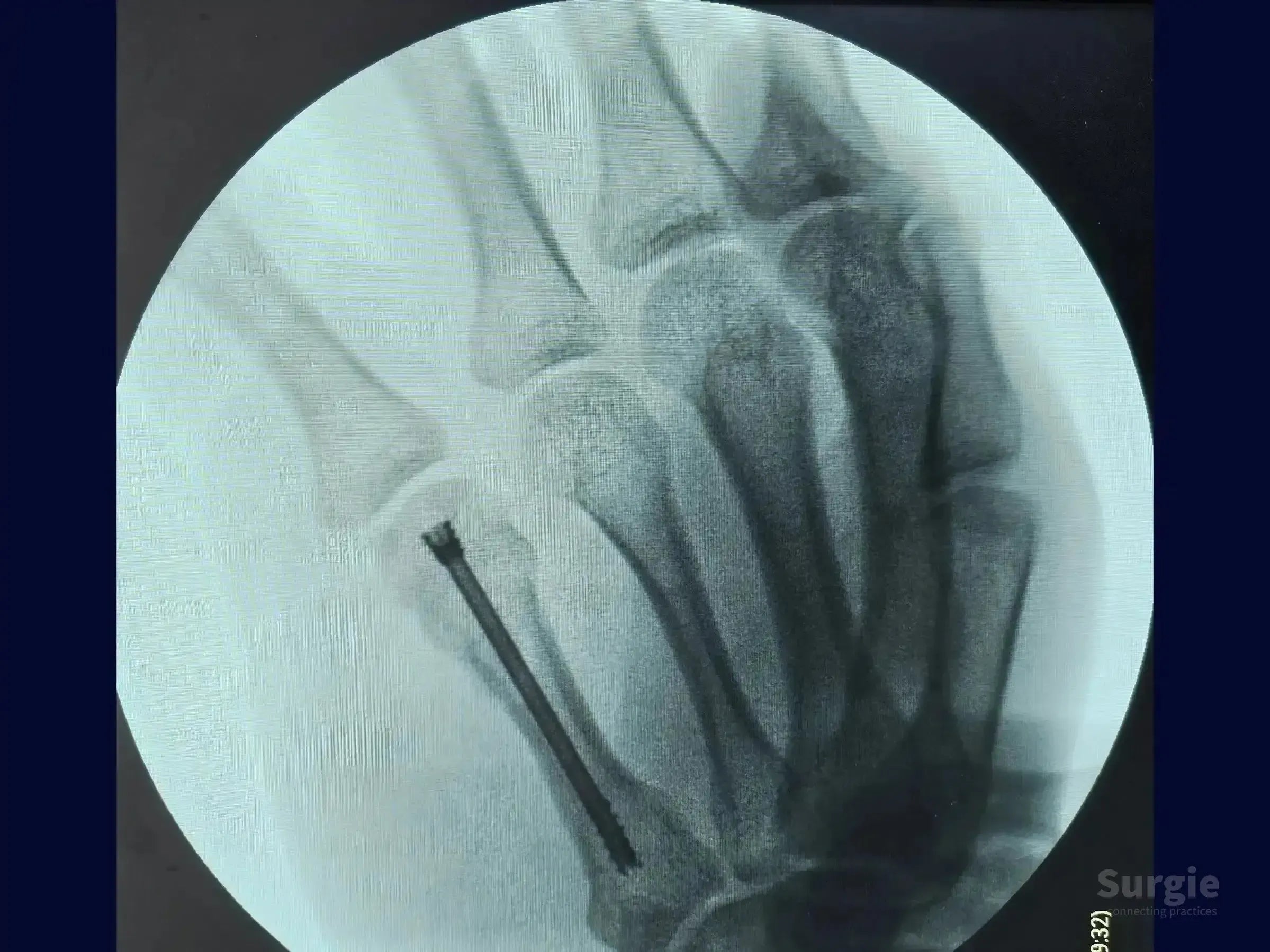 X-ray of a fifth metacarpal boxer's fracture fixed with a metallic double-compression screw in the hand.