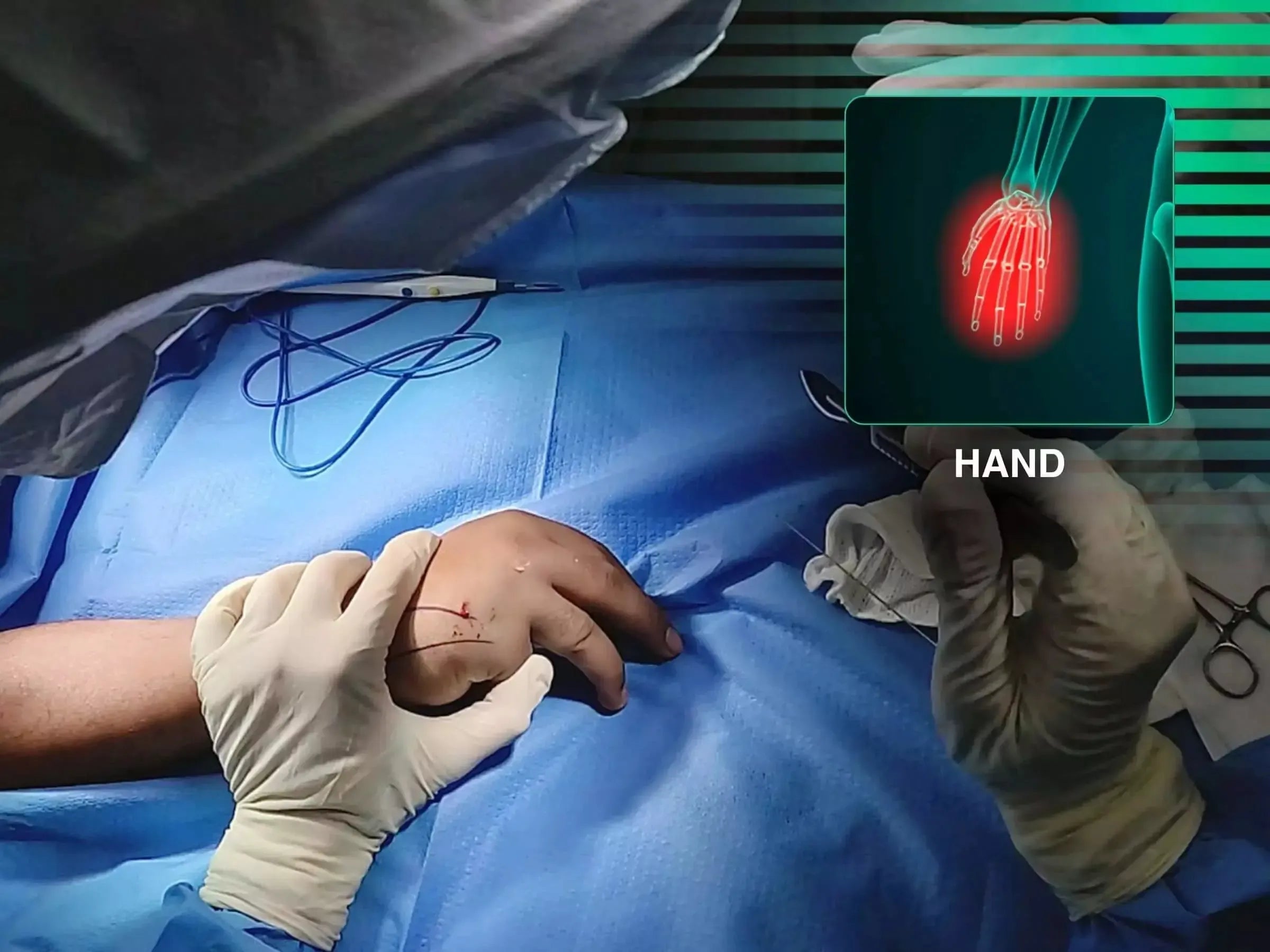 Fracture of the Neck of the Fifth Metacarpal (Boxer's Fracture)