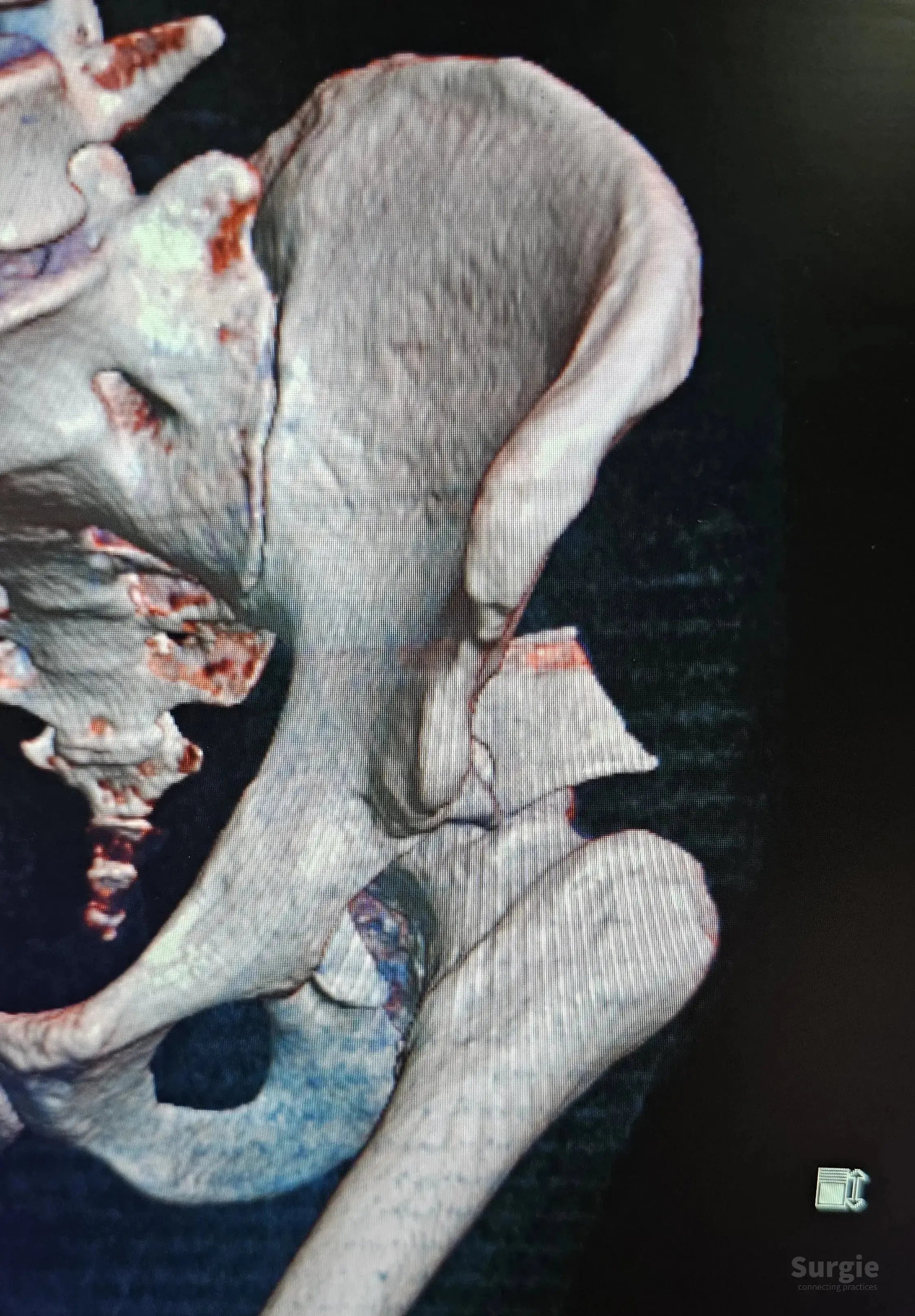 3D CT scan showing a posterior acetabular wall fracture with hip dislocation in a grey bone model.
