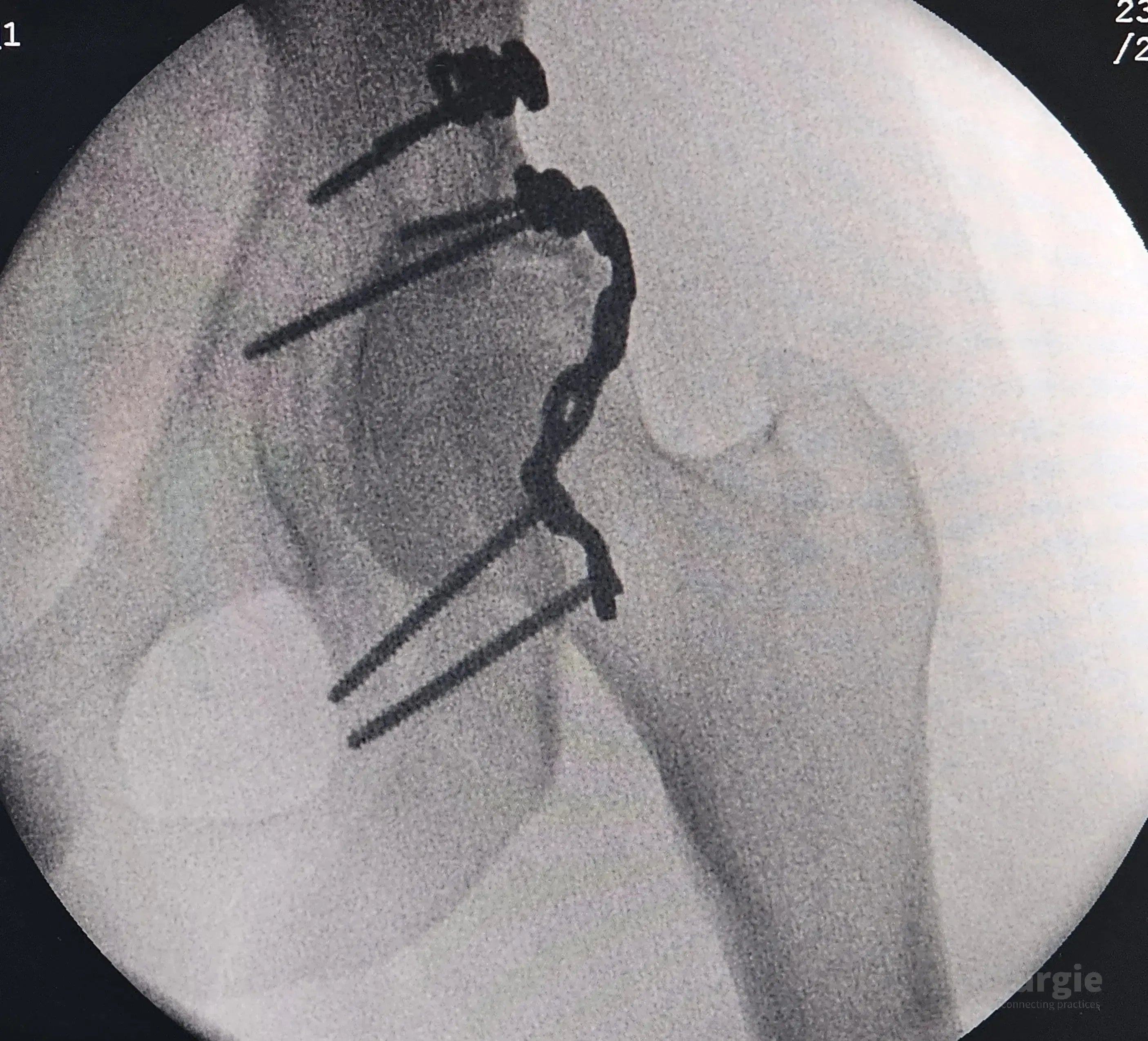 X-ray showing a posterior acetabular wall fracture fixed with a contoured metal plate and multiple surgical screws.