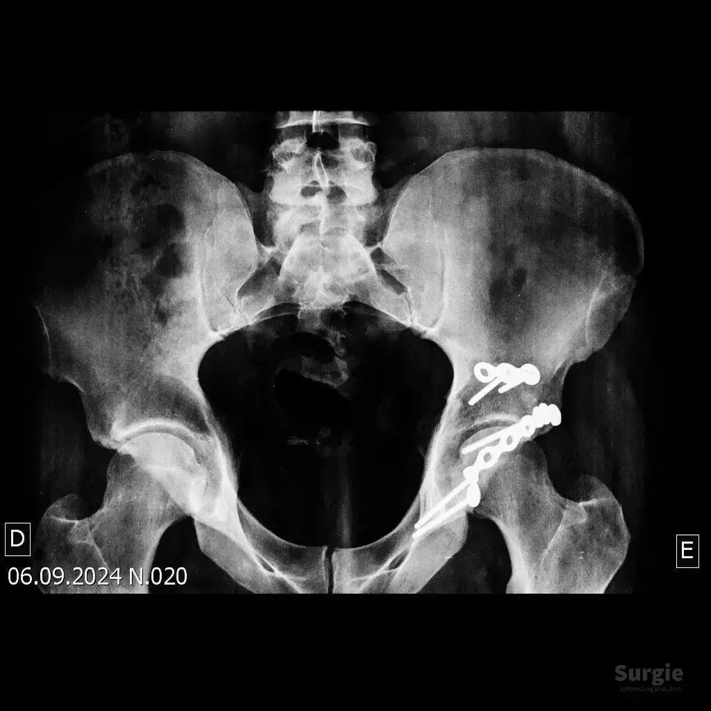 Pelvic X-ray showing a posterior acetabular wall fracture fixed with a metal plate and screws on the left hip.