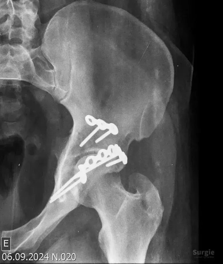 X-ray showing a posterior acetabular wall fracture fixed with metal plates and screws to restore hip joint anatomy.