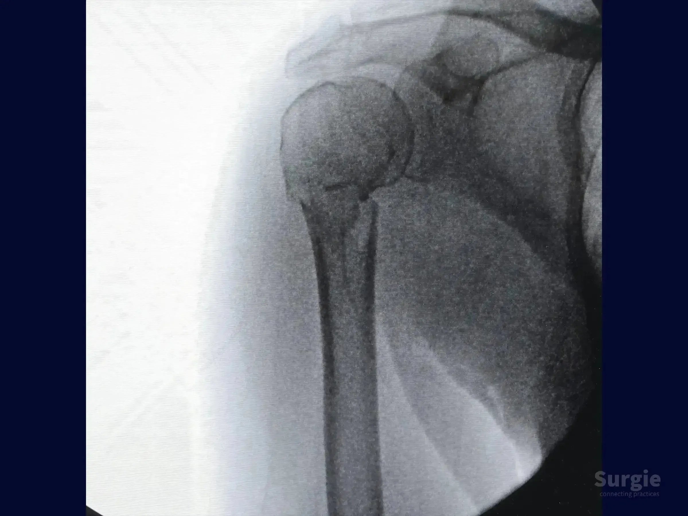 X-ray showing a two-part proximal humerus fracture with clear displacement of the humeral head.
