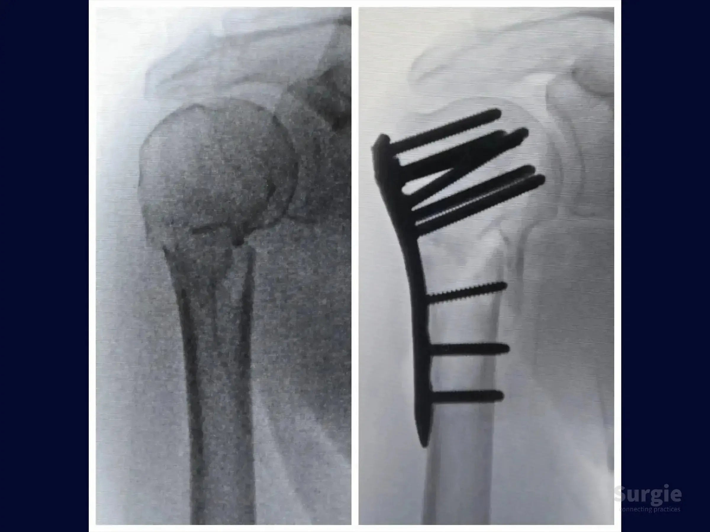 X-ray showing a 2-part proximal humerus fracture before and after surgical fixation with a metal plate and screws.