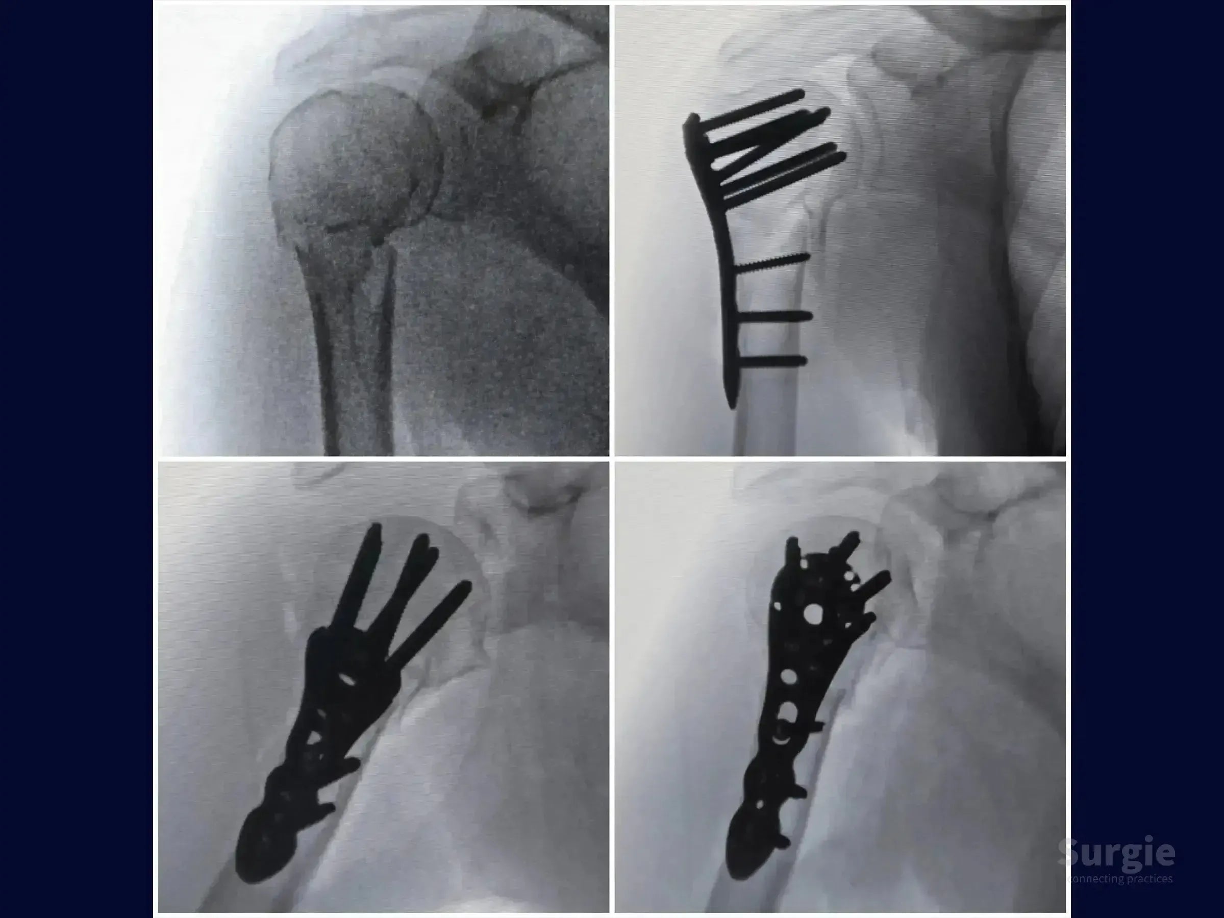 X-ray sequence showing a 2-part proximal humerus fracture treated with a locking plate and screws via deltopectoral approach.