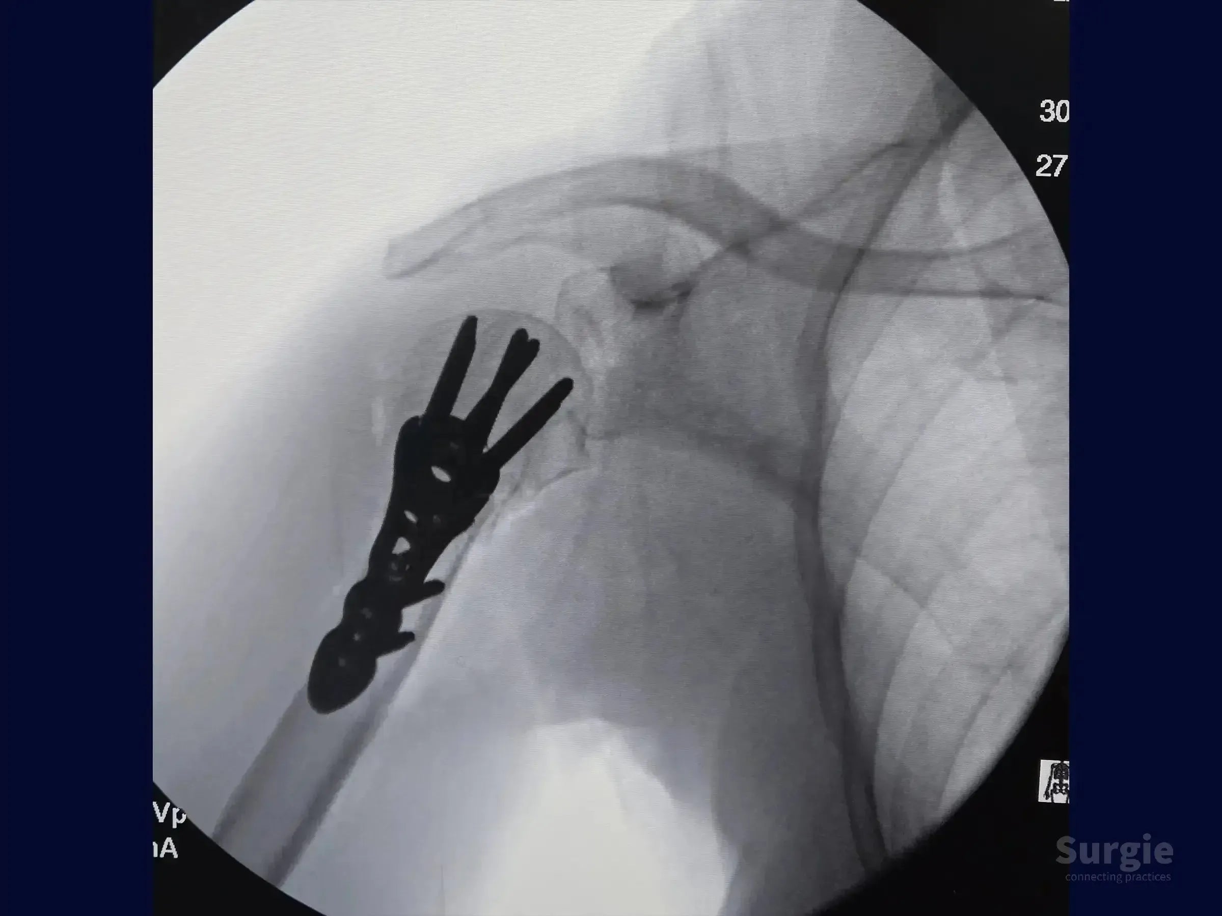 X-ray showing a proximal humerus fracture fixed with a metal plate and subchondral screws in the humeral head.