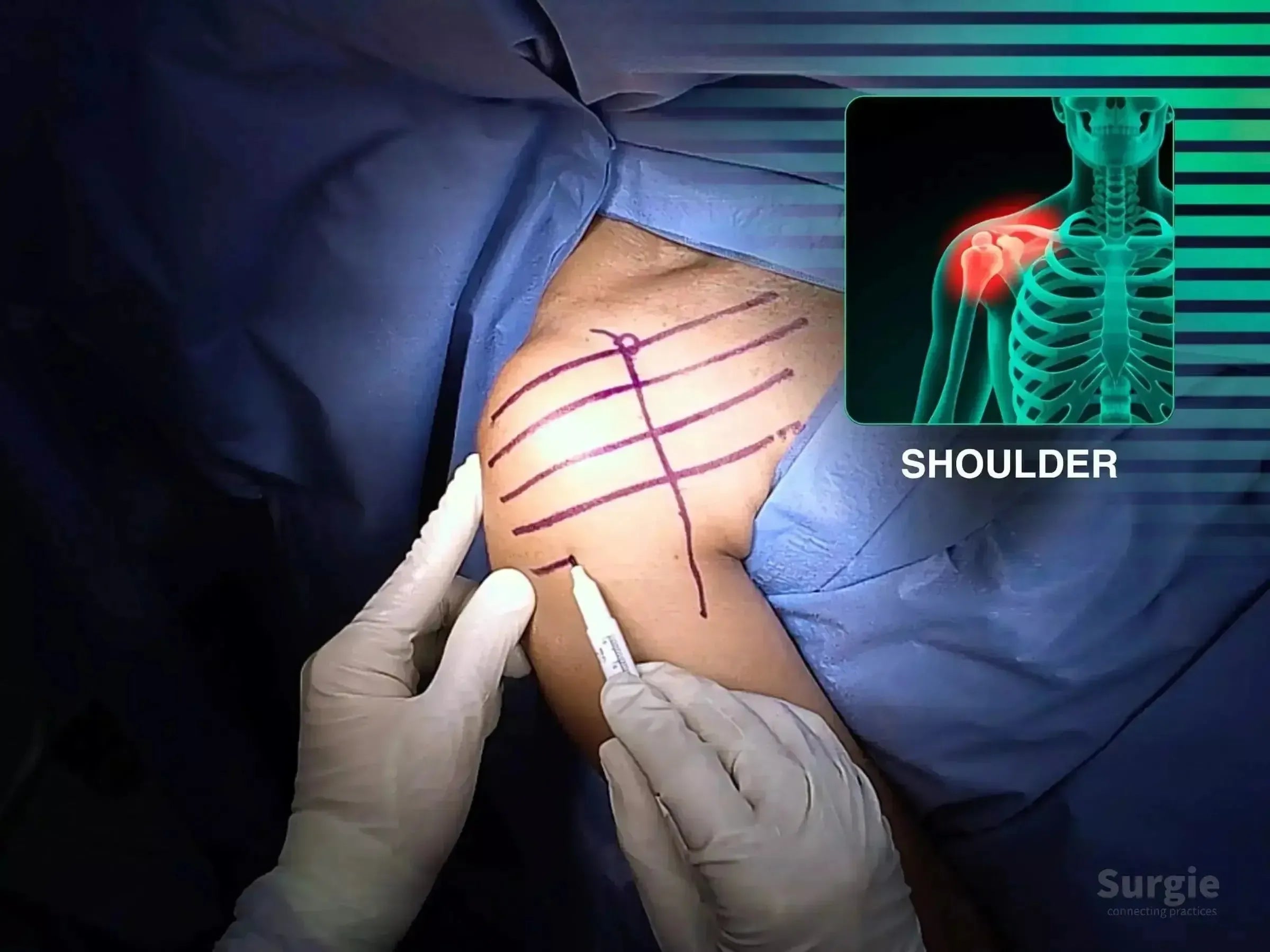 Surgeon marking incision lines on a patient's shoulder for a deltopectoral approach with a skeletal anatomy overlay.
