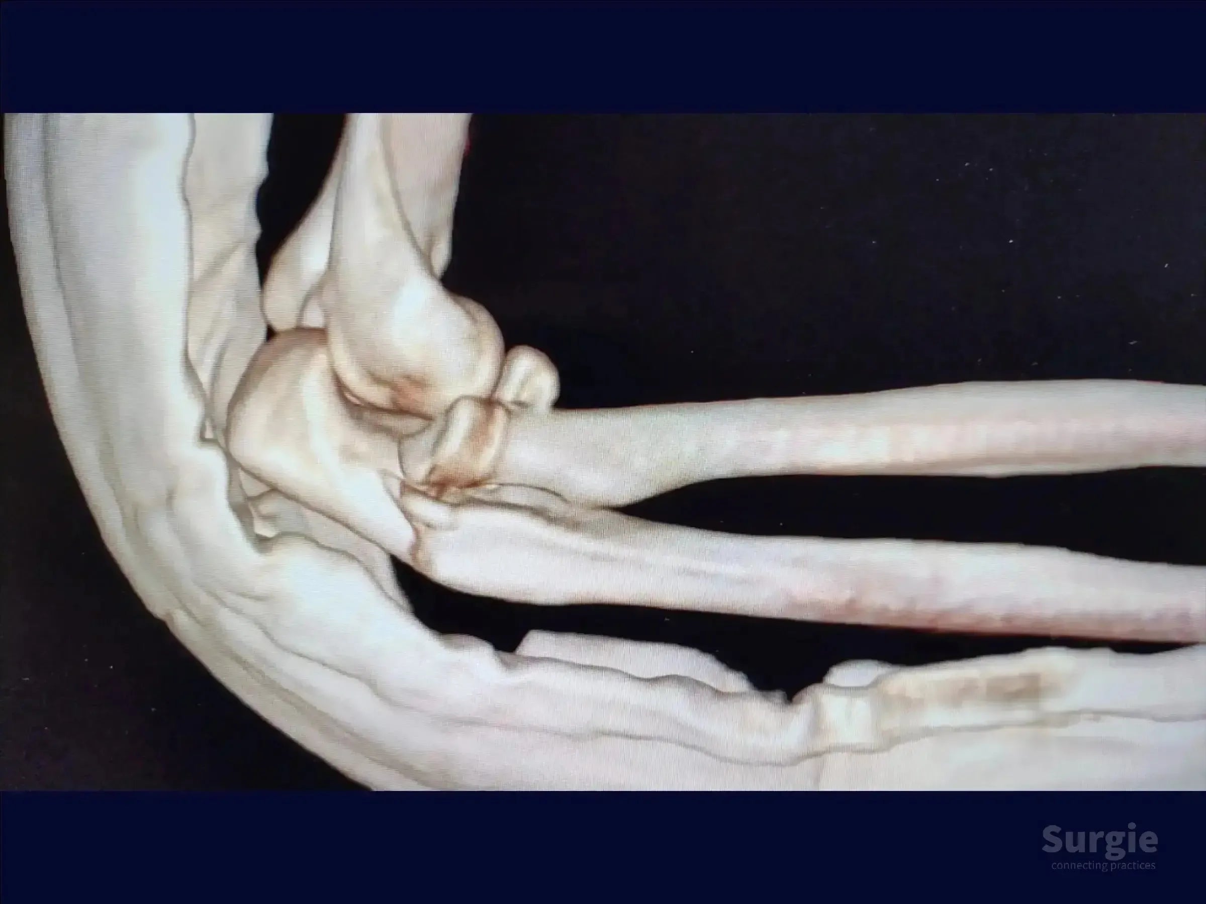 3D CT scan showing a Monteggia variant elbow injury with proximal ulna fracture and radial head dislocation.