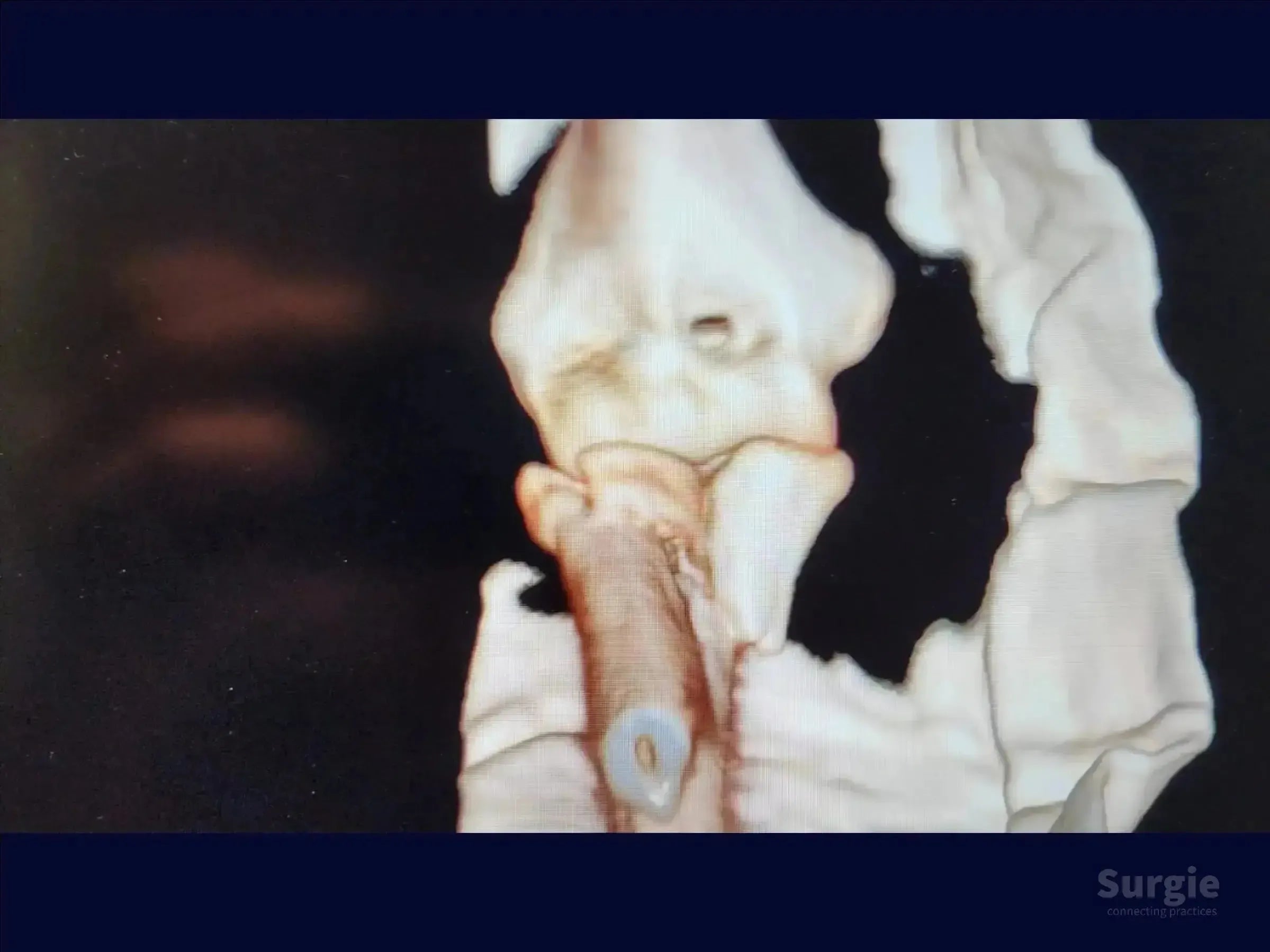 3D CT scan showing a proximal ulna metaphyseal fracture with radial head dislocation and fracture.