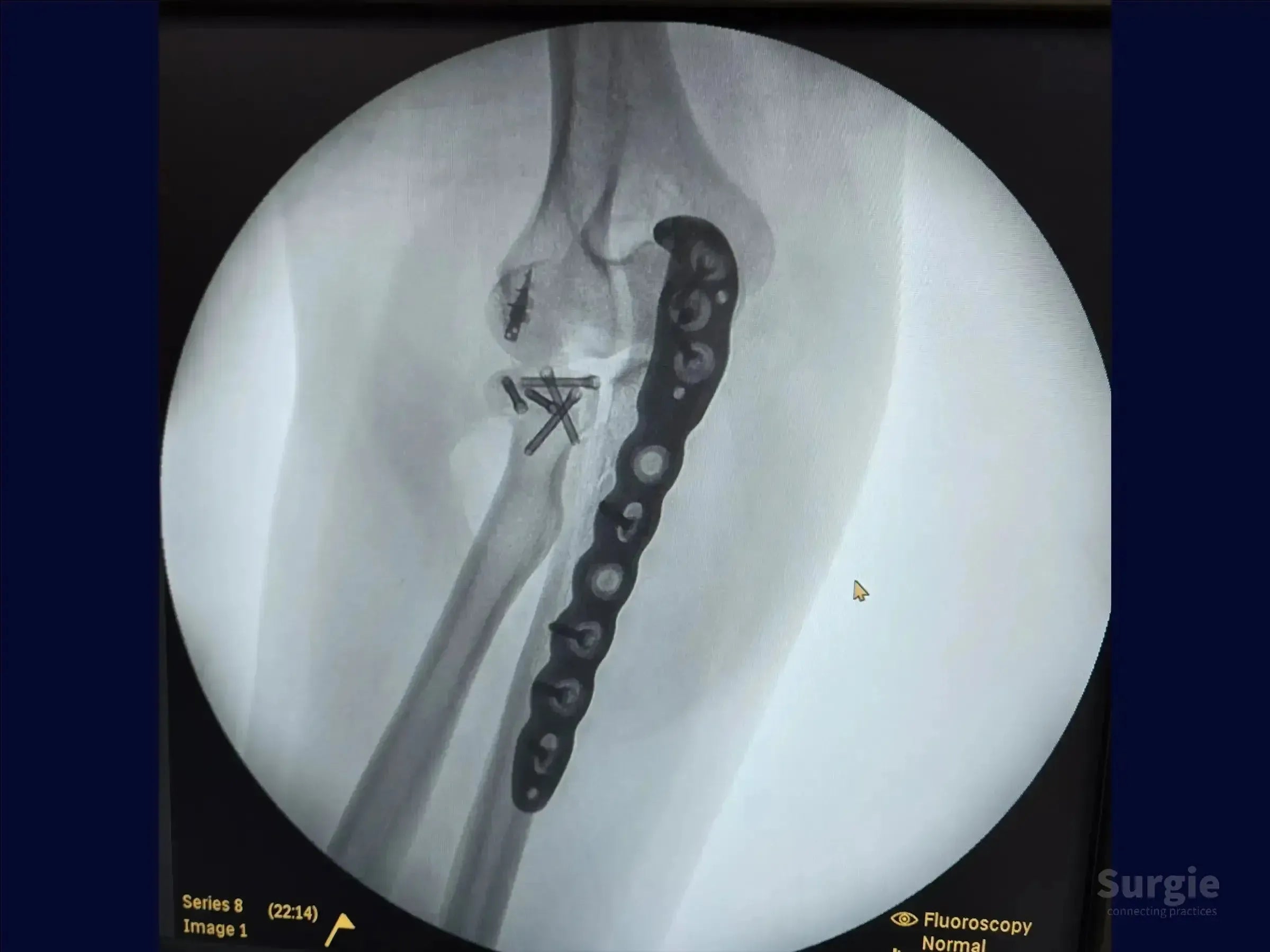 X-ray showing a metal plate and screws fixating a proximal ulna fracture and radial head injury in the elbow.