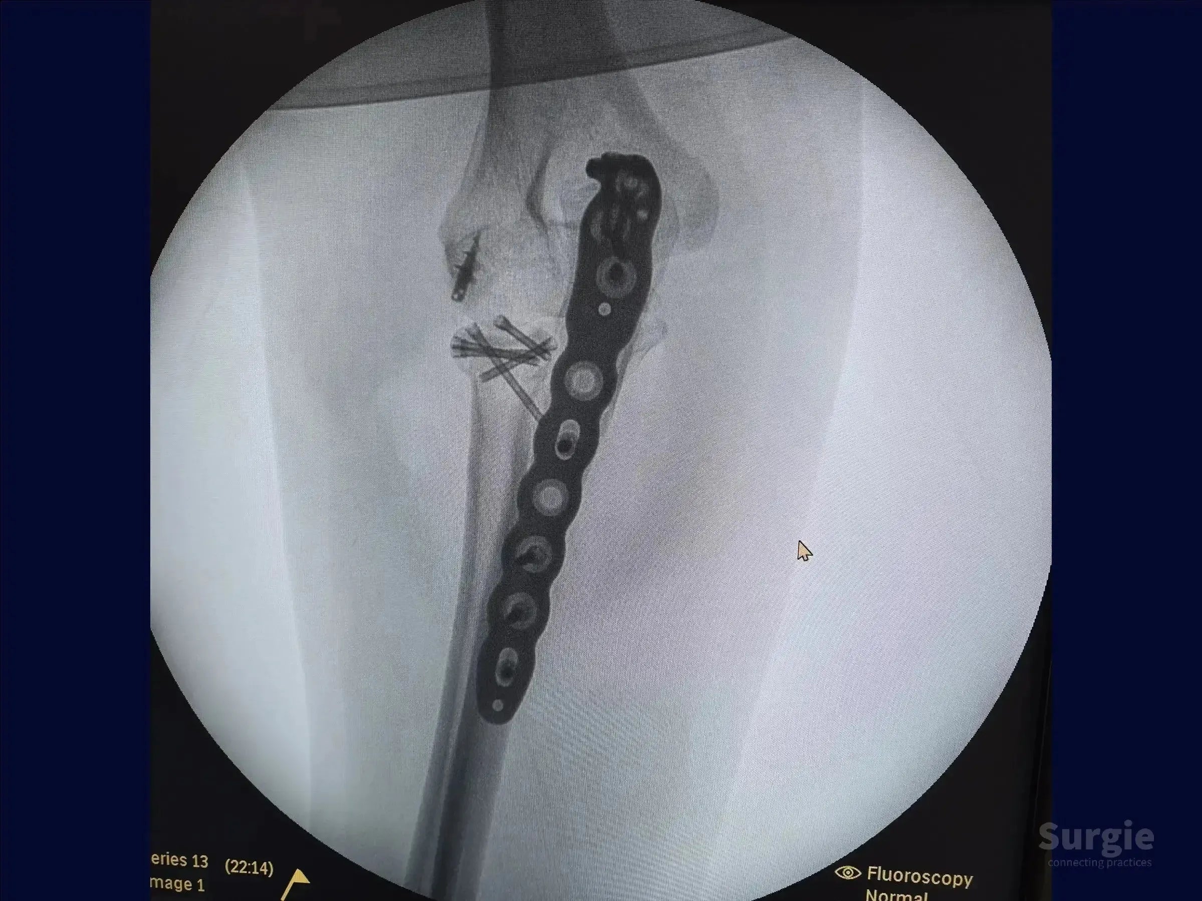 X-ray showing a metal plate and screws fixating a proximal ulna fracture with radial head reduction.