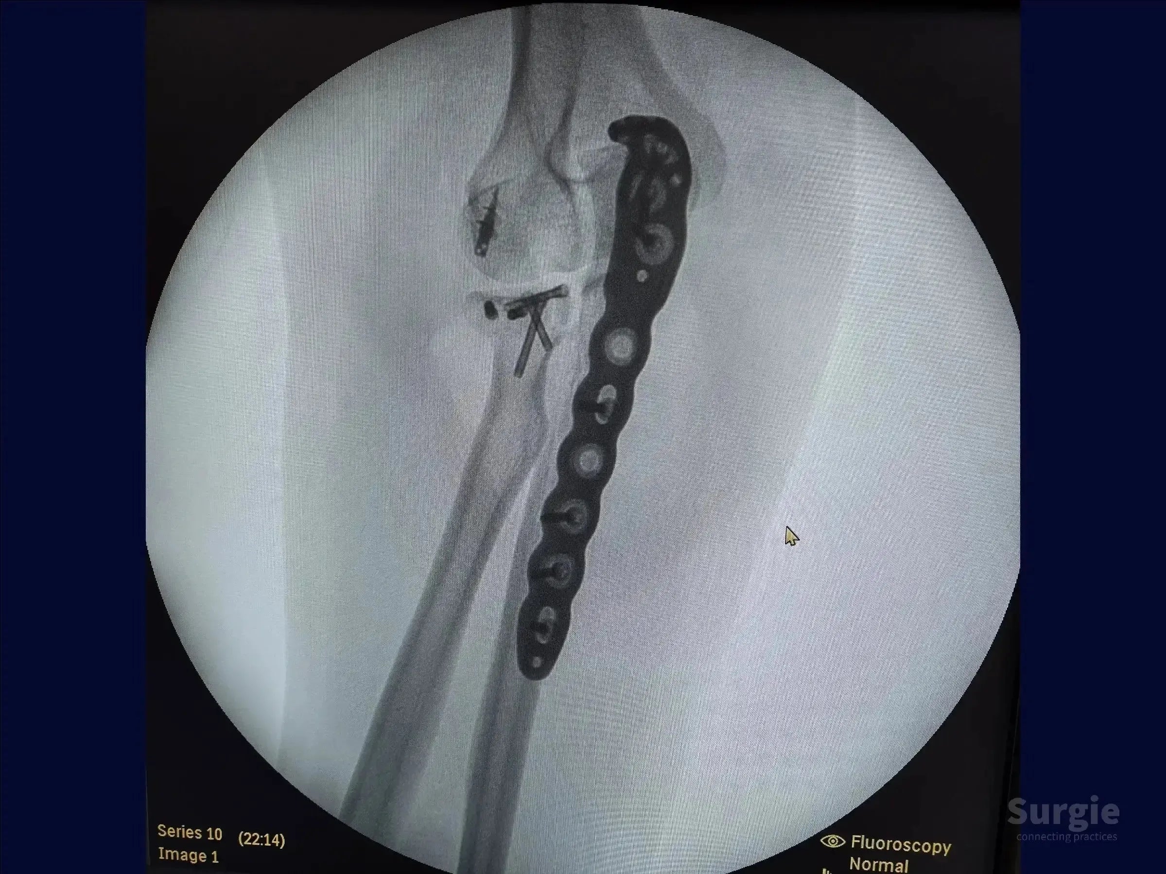 X-ray showing a Monteggia variant fracture fixed with a metal plate and screws on the proximal ulna and radial head.