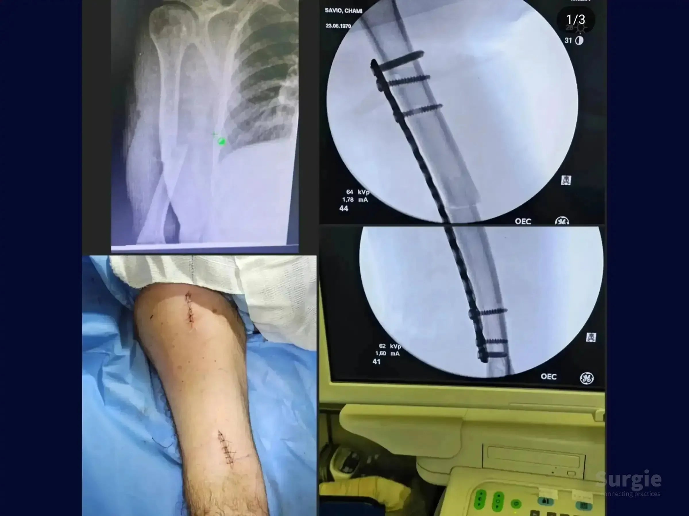 X-ray and surgical view of a humeral shaft fracture repaired with a metal bridge plate and screws via minimally invasive incisions.
