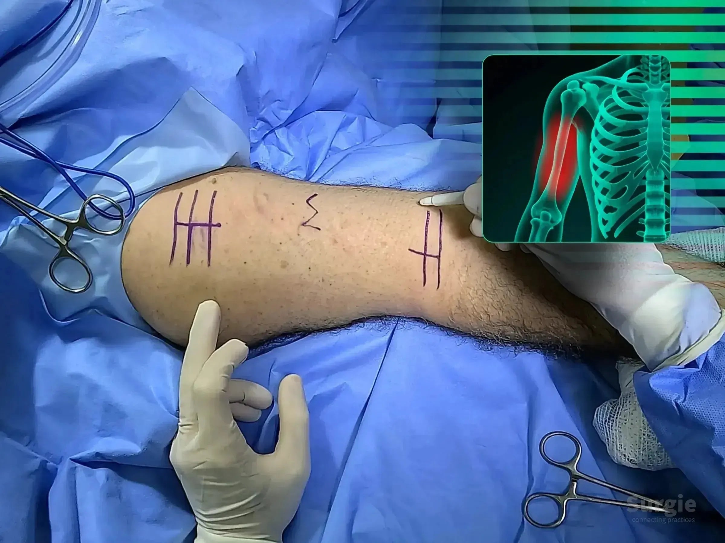 Surgical site on an arm with pre-operative markings and a digital X-ray overlay showing a humeral shaft fracture.