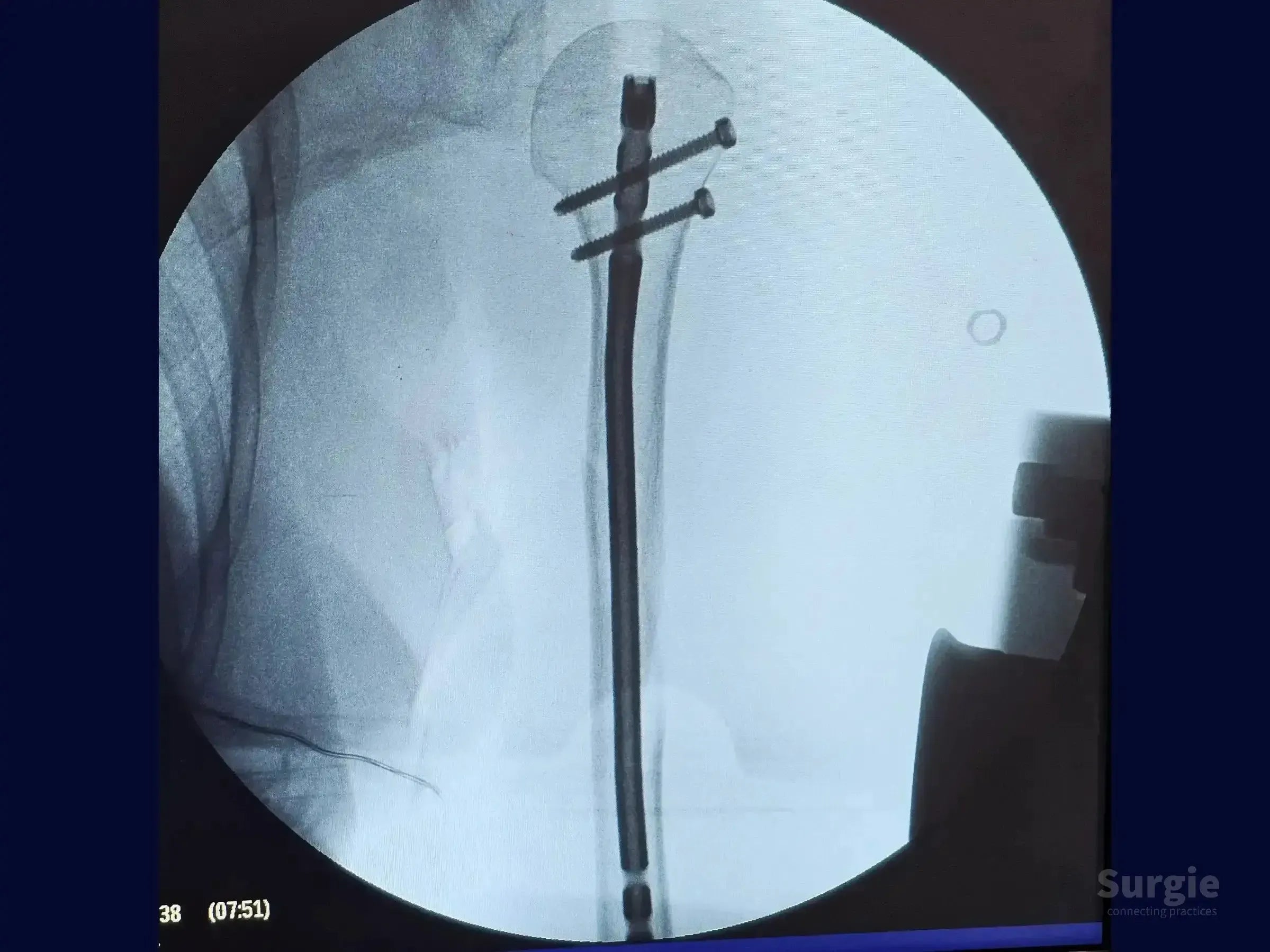 X-ray showing a humeral shaft fracture stabilized with an intramedullary nail and two proximal locking screws.