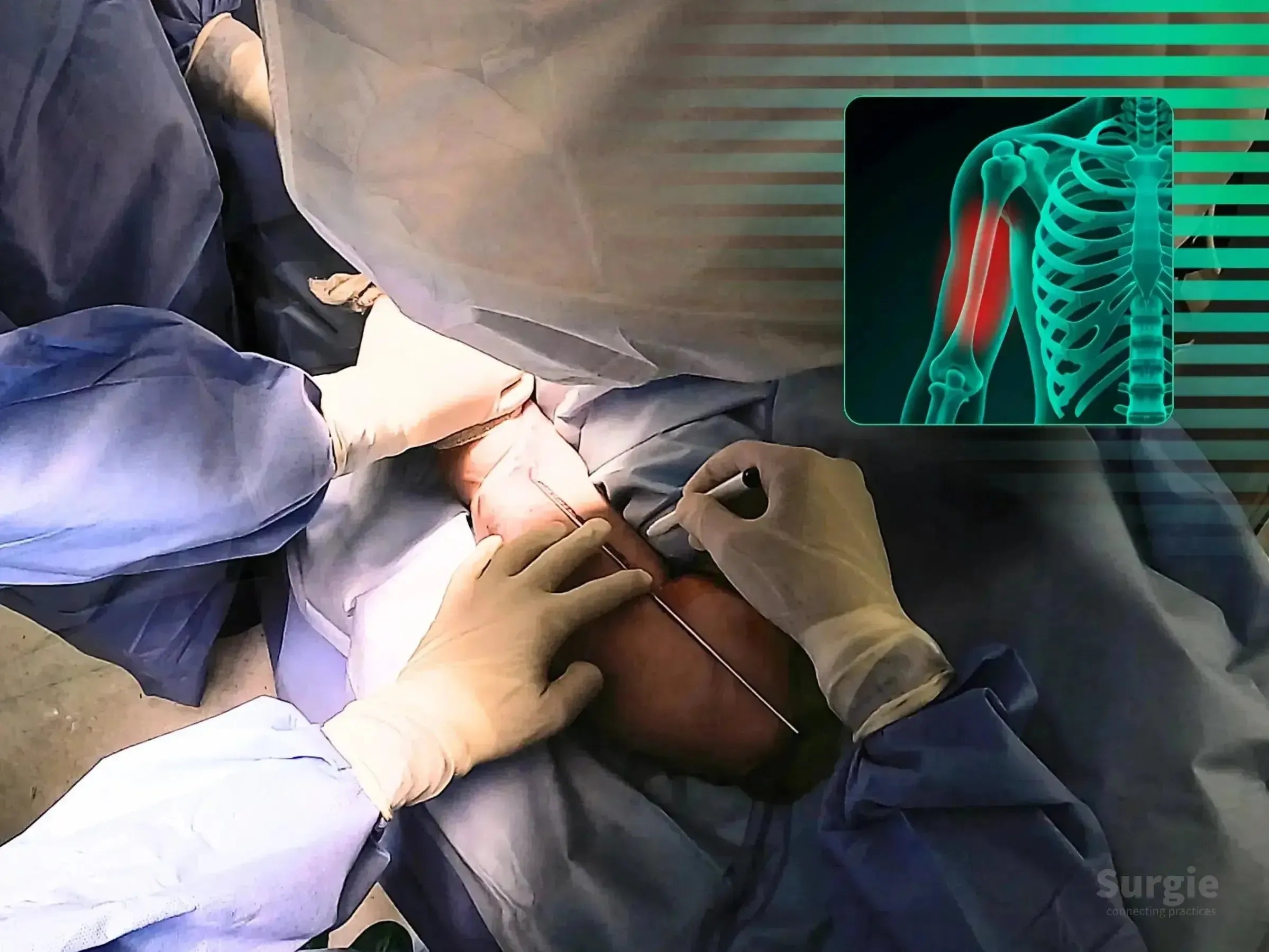Surgeon marking a humeral shaft fracture site with a guide wire and marker, featuring an anatomical bone overlay.