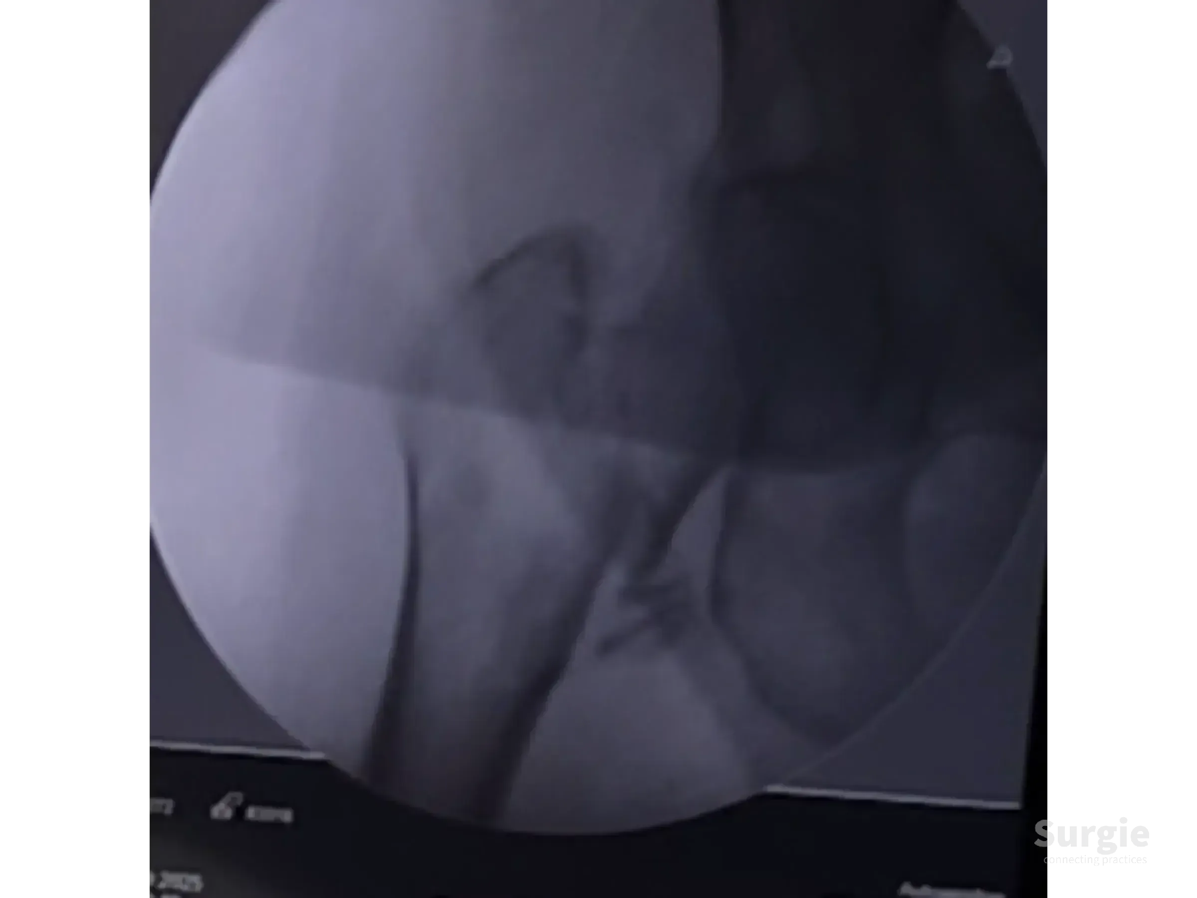 Fluoroscopic X-ray showing an intramedullary nail in the proximal femur during a reduction maneuver.