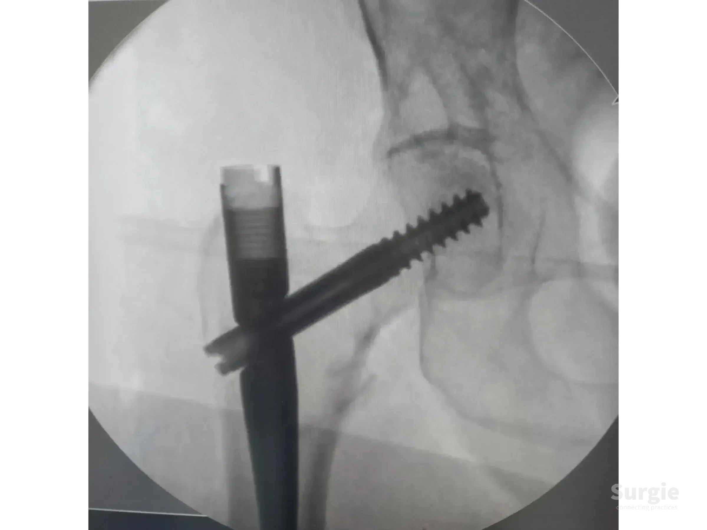 Fluoroscopic view of a proximal femoral intramedullary nail with a cephalic screw inserted into the hip joint.