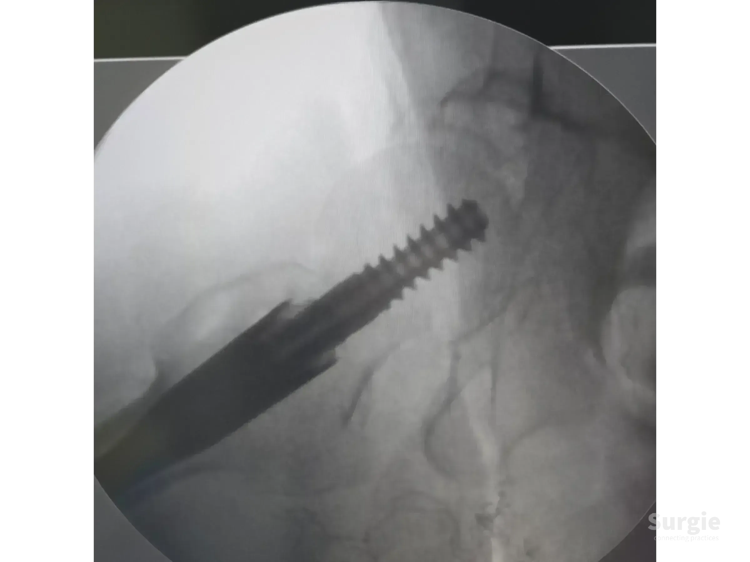Fluoroscopic view of a proximal femoral intramedullary nail and cephalic screw during surgical reduction of a fracture.