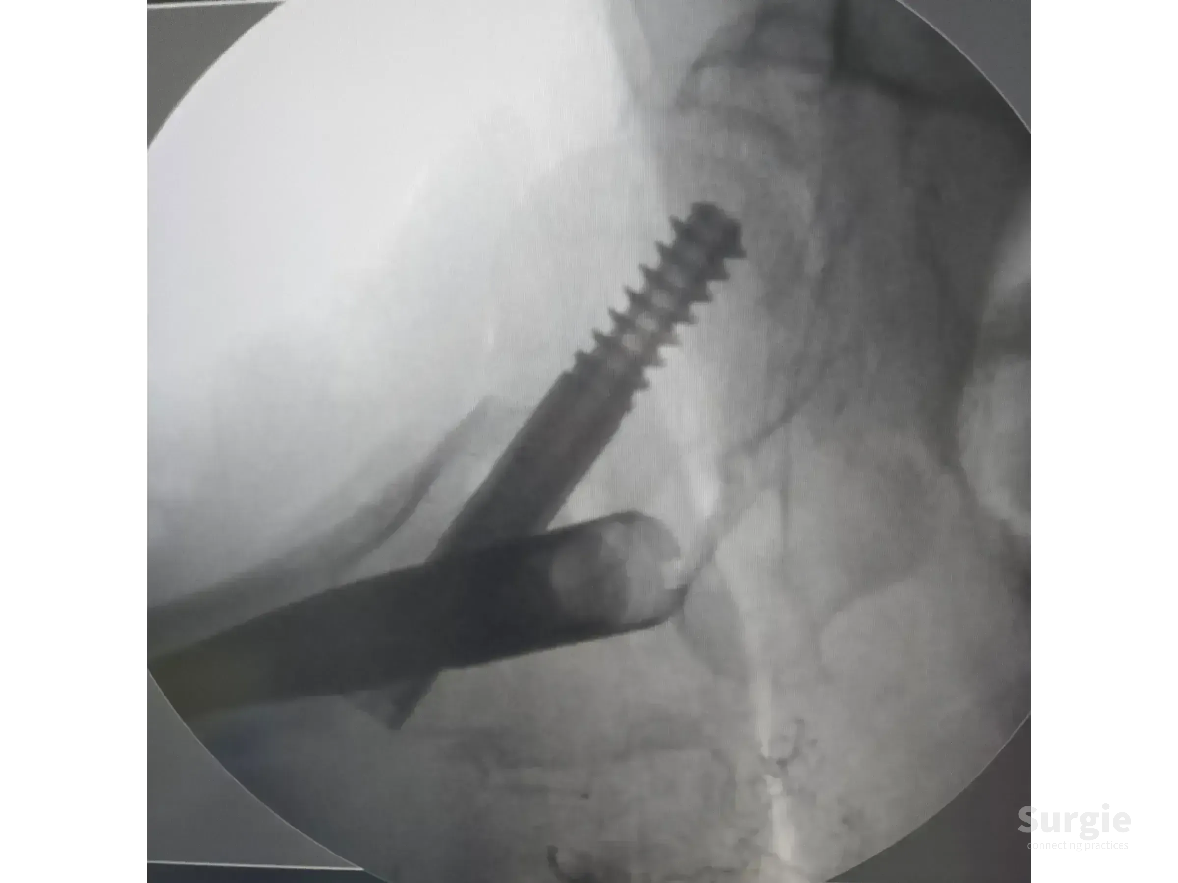 Fluoroscopic view of a metallic intramedullary nail and cephalic screw inserted into a proximal femur fracture.