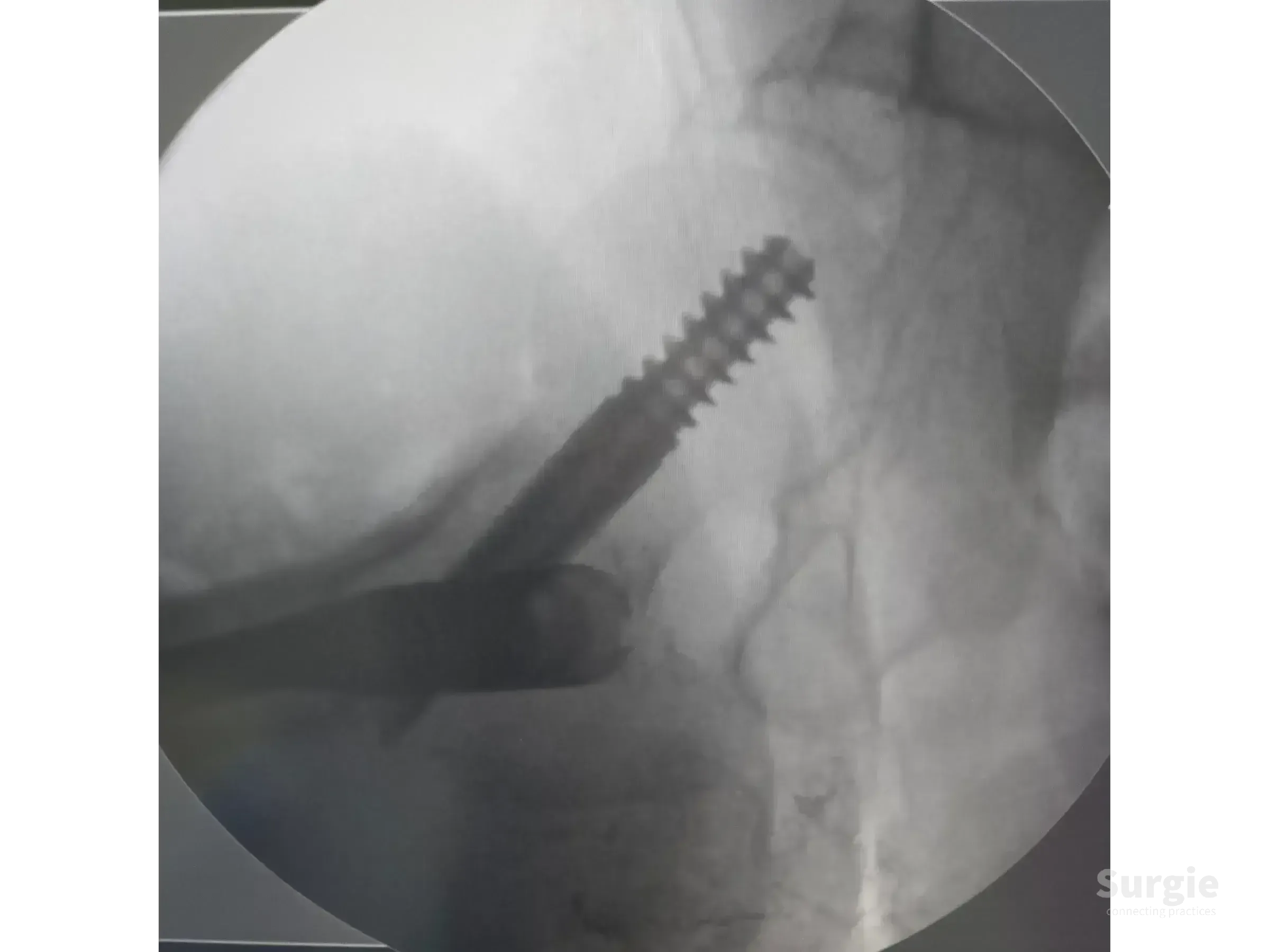 Fluoroscopic view of a proximal femoral intramedullary nail and cephalic screw during a reduction maneuver.