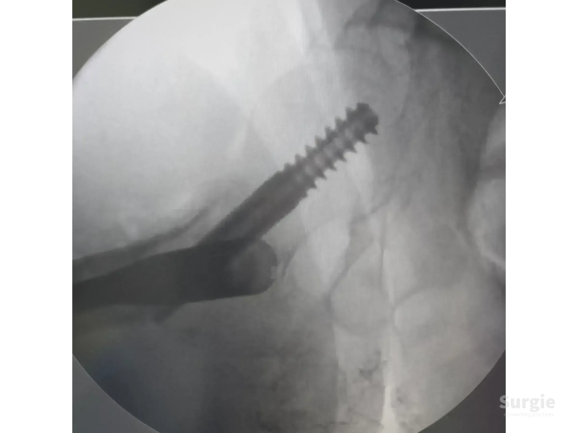 Fluoroscopic X-ray showing a metallic intramedullary nail and cephalic screw in a proximal femur fracture reduction.