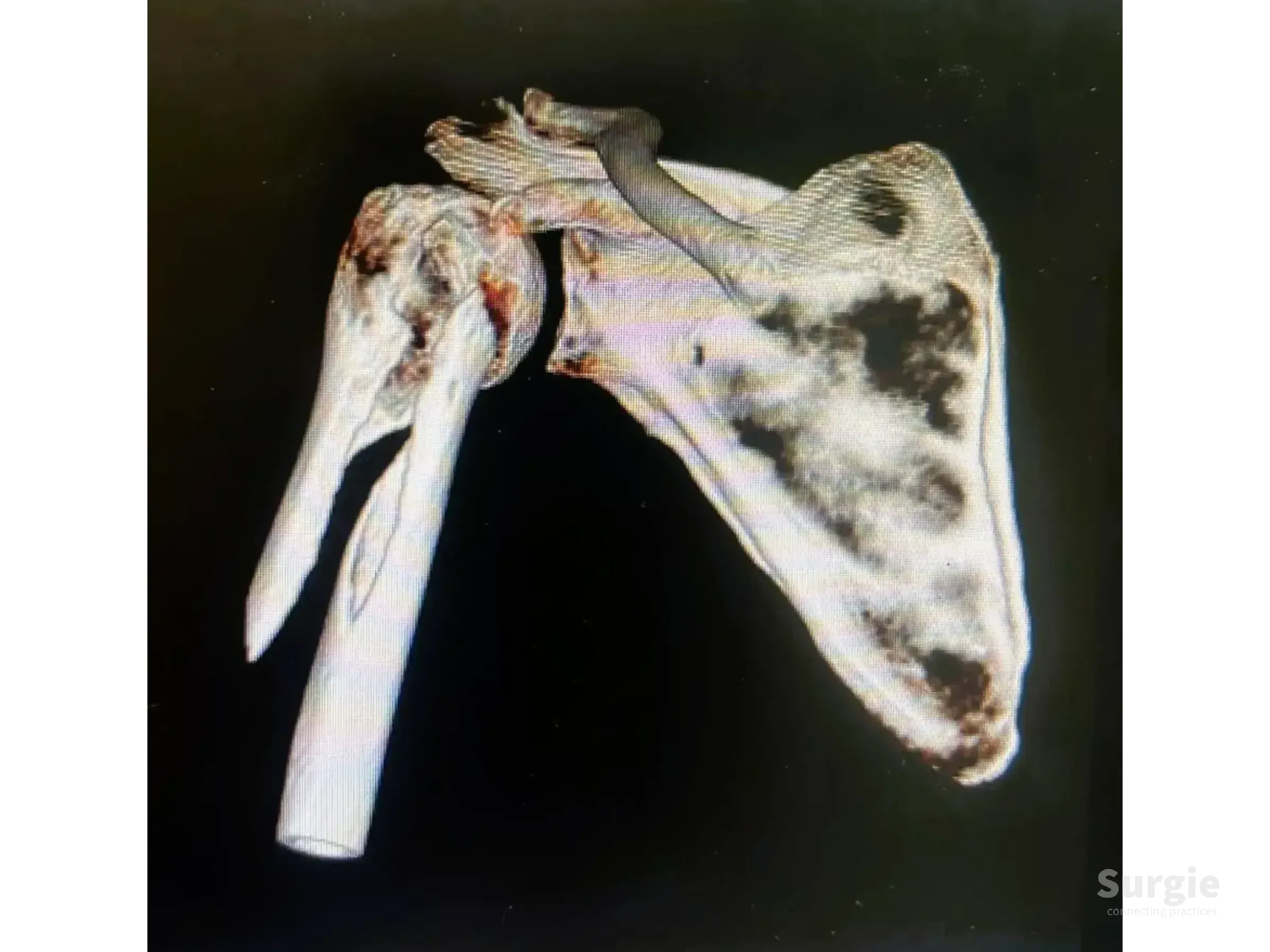 3D CT scan showing a proximal humerus fracture with an intramedullary nail inserted into the bone shaft.