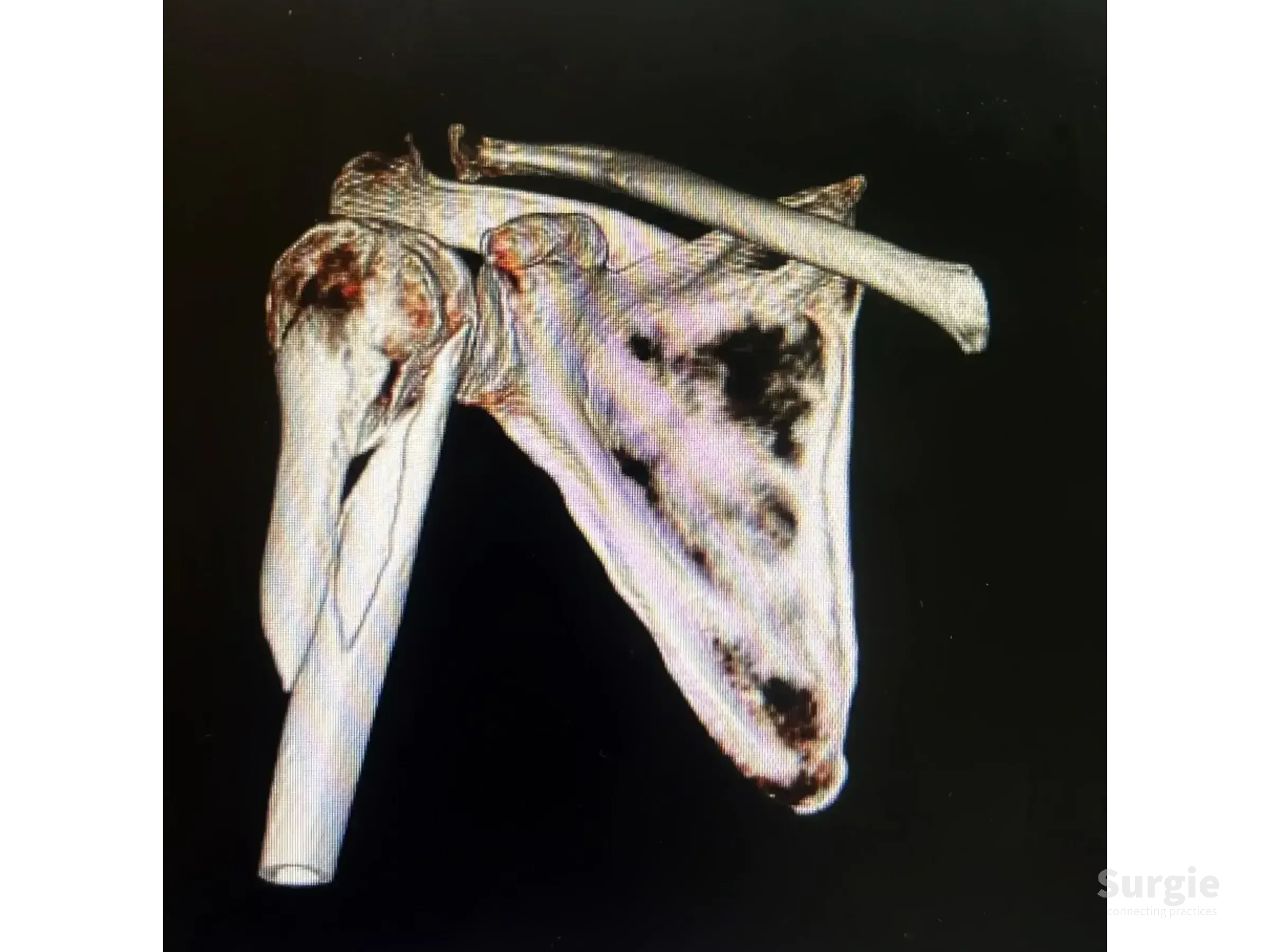 3D medical scan showing a proximal humerus fracture stabilized with a metallic intramedullary nail and locking screws.