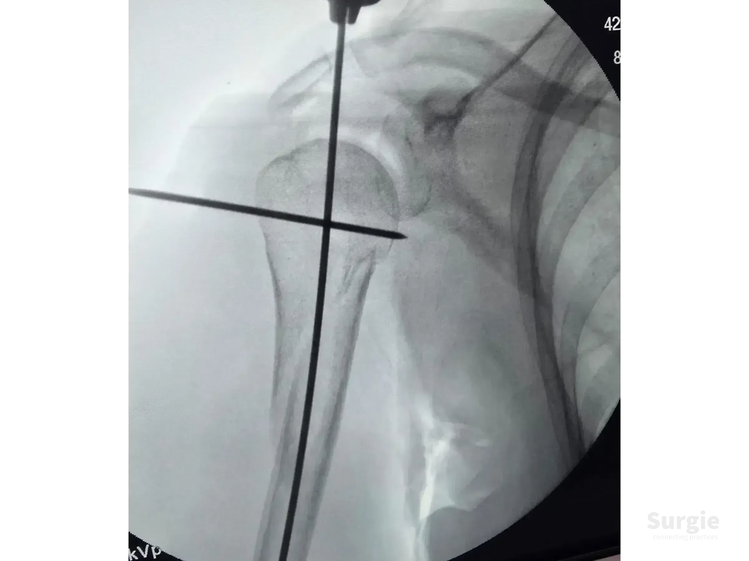 Fluoroscopic view of a proximal humerus fracture stabilized with a metallic guide wire and Kirschner wire joystick.