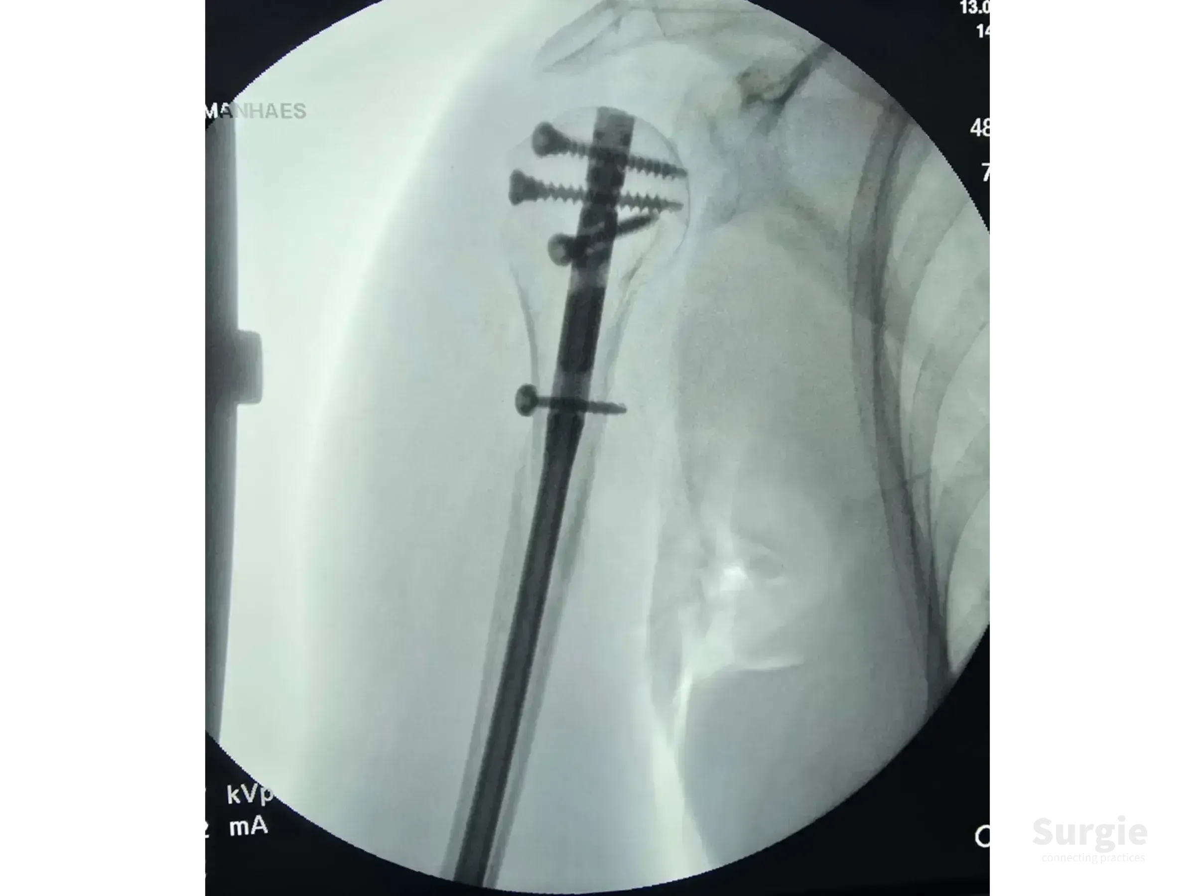 Fluoroscopic X-ray showing a metallic intramedullary nail with proximal locking screws in a humerus fracture.