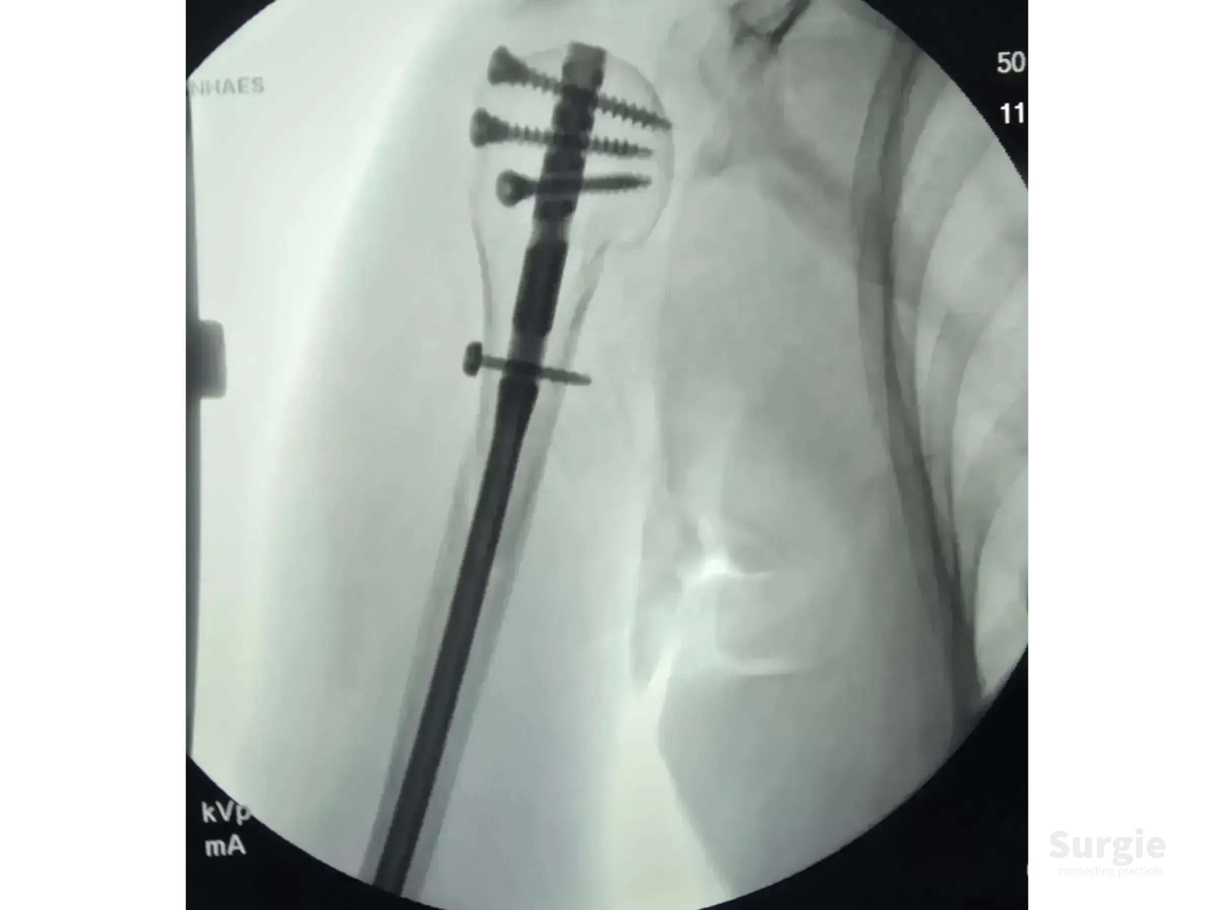 Fluoroscopic X-ray showing a proximal humerus intramedullary nail with multiple locking screws in the humeral head.