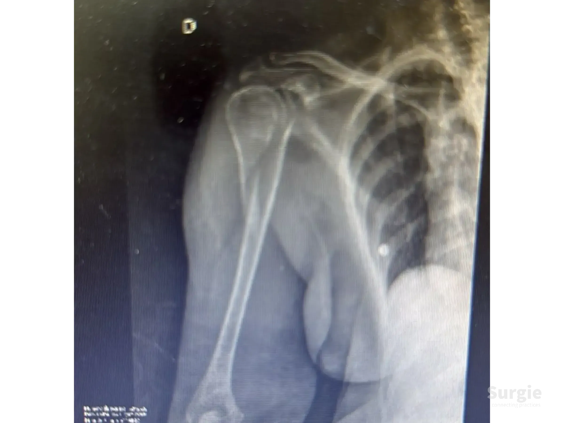 Fluoroscopic X-ray showing a metallic intramedullary nail implanted in a fractured proximal humerus bone.