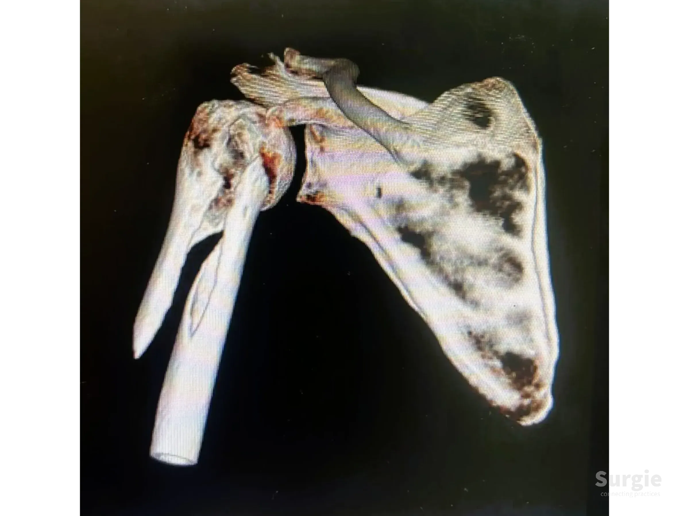 3D CT scan showing a proximal humerus fracture stabilized with a long intramedullary nail against a black background.