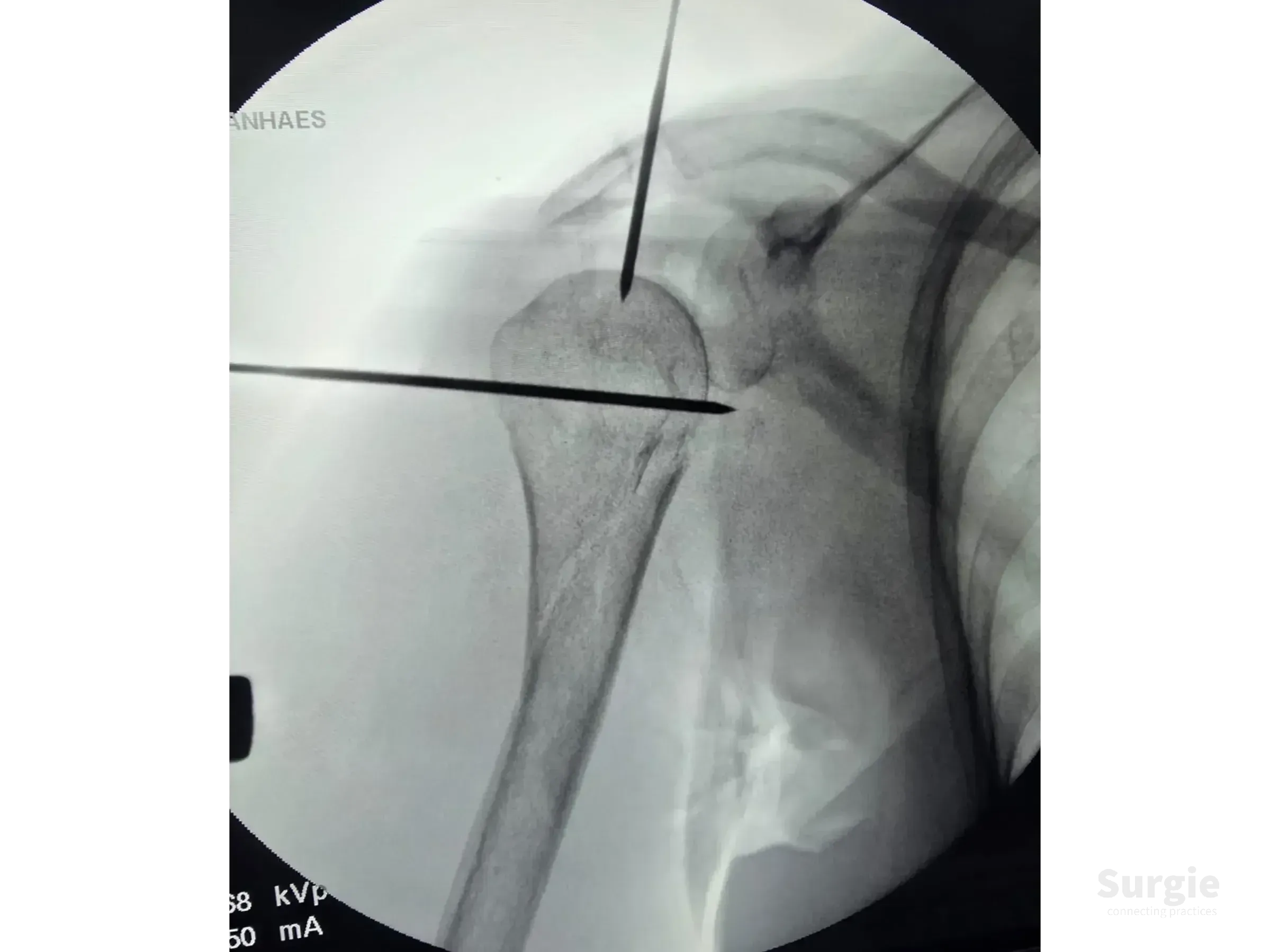 Fluoroscopic view of a proximal humerus fracture with Kirschner wires inserted for surgical stabilization.