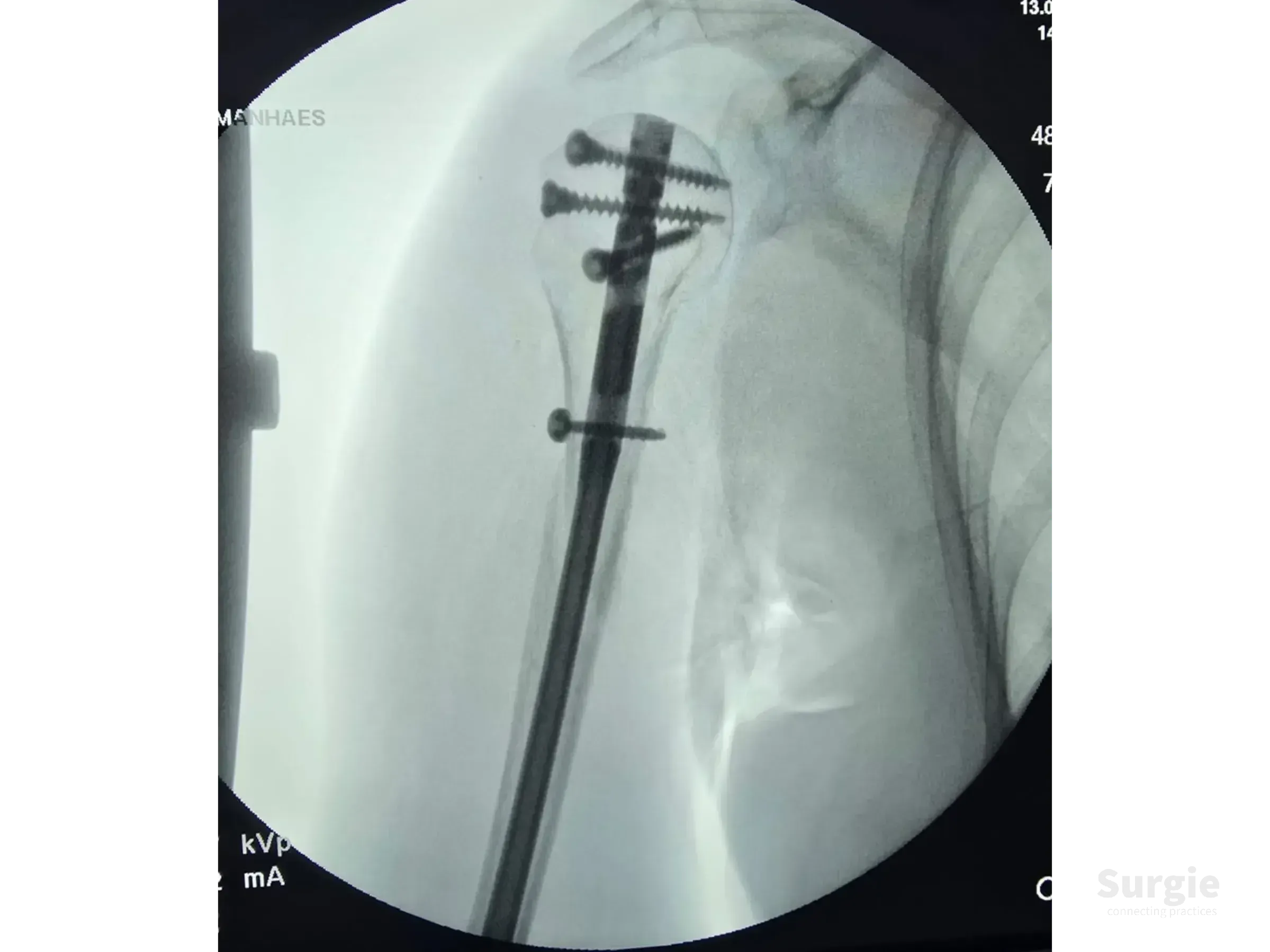 Fluoroscopic X-ray showing a metallic intramedullary nail with proximal locking screws stabilizing a proximal humerus fracture.