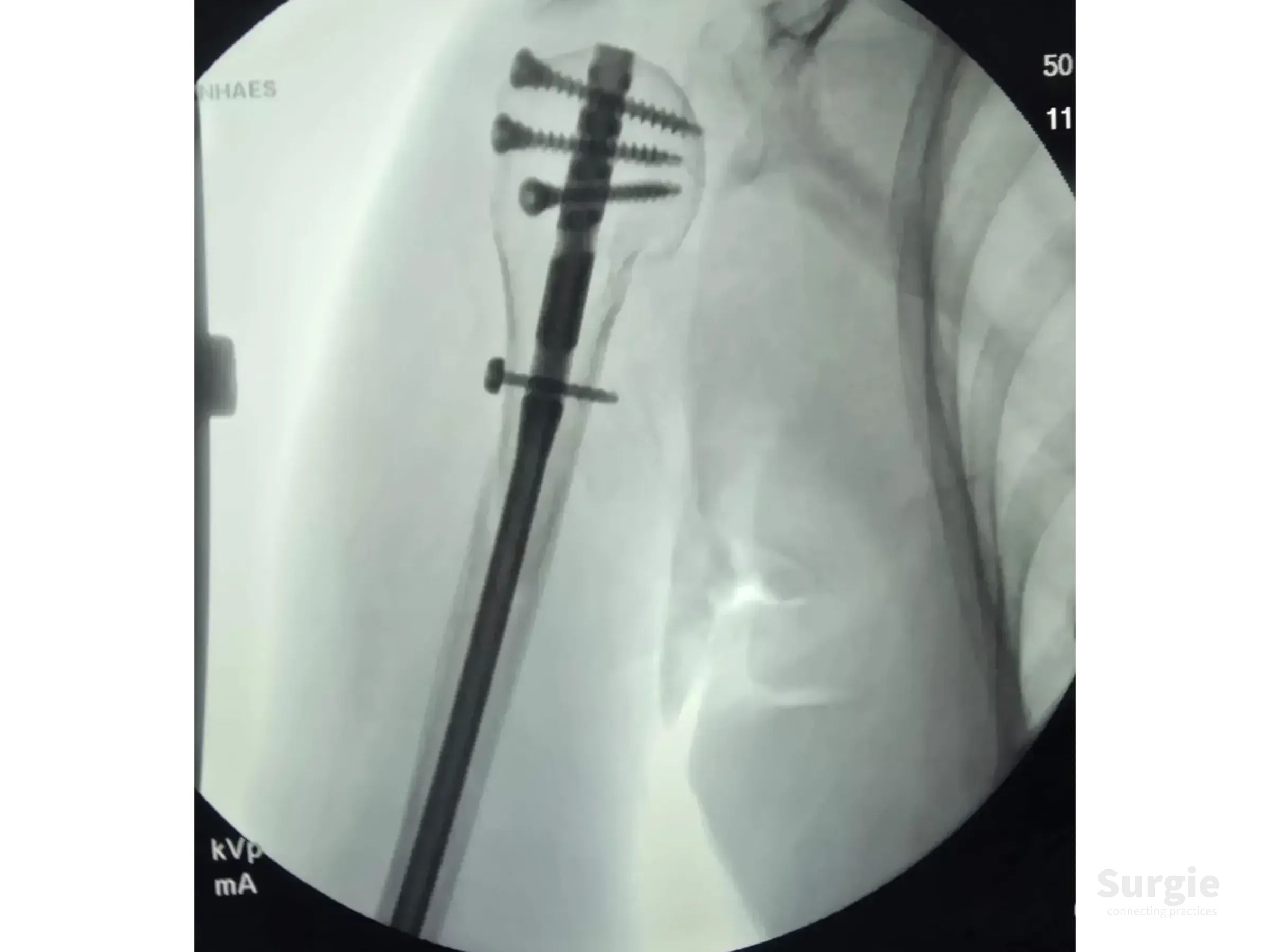 Fluoroscopic X-ray showing a metal intramedullary nail with proximal locking screws stabilizing a humerus fracture.
