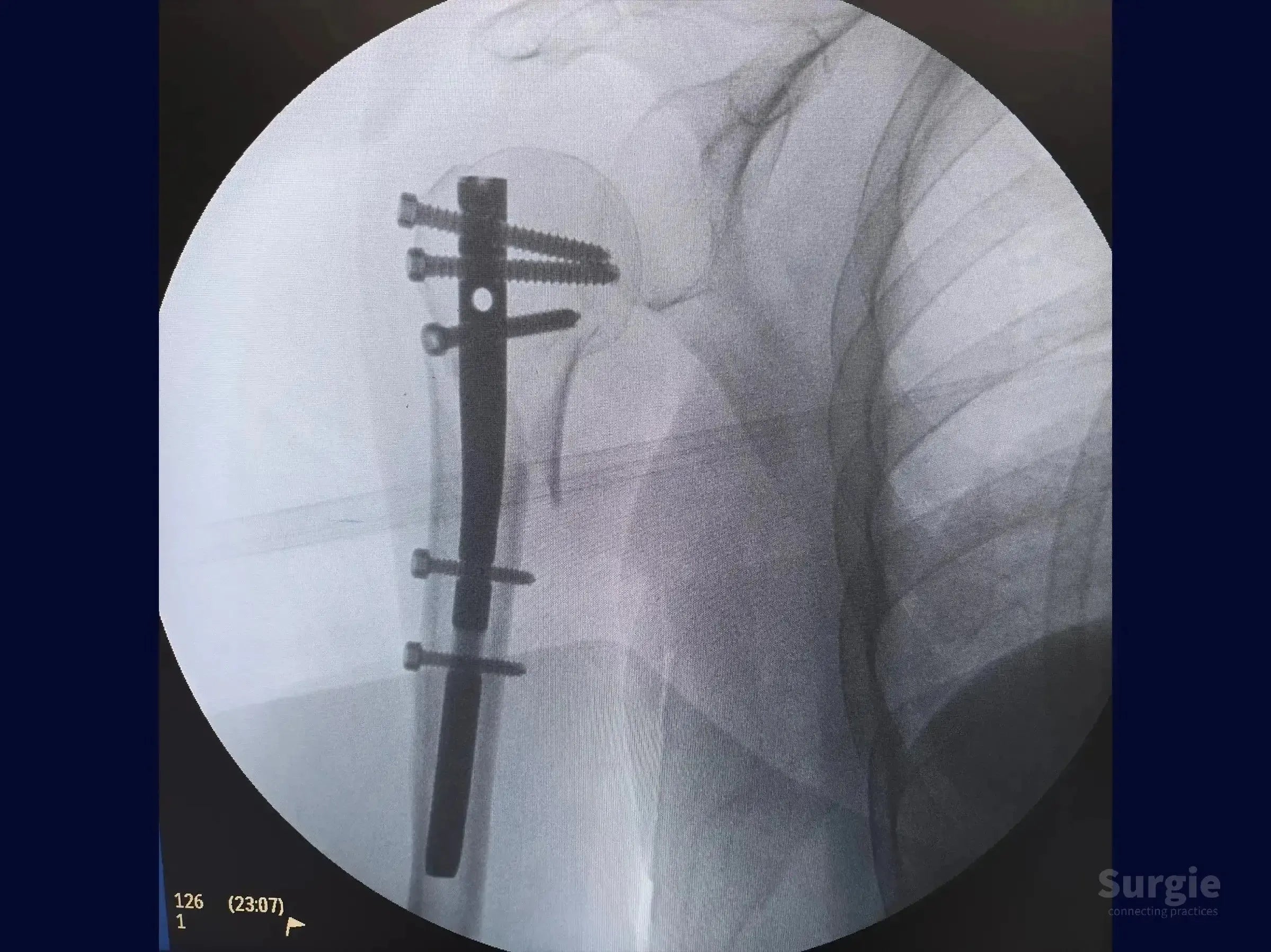 Fluoroscopic X-ray showing a proximal humerus intramedullary nail with locking screws in the humeral head and shaft.